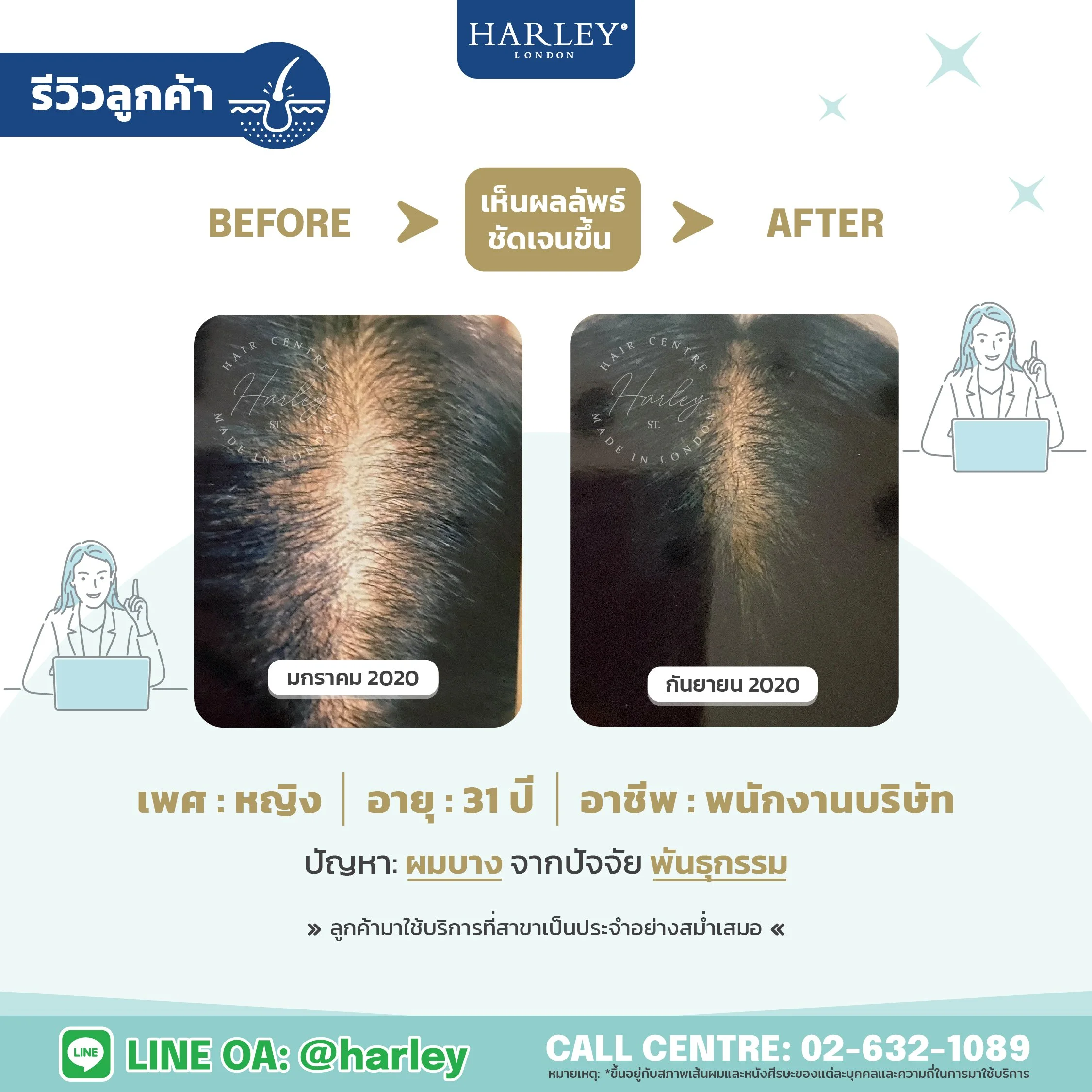 รีวิวลูกค้าหญิง อายุ 31 ปี ผมบางจากพันธุกรรม — Harley St. Hair Centre