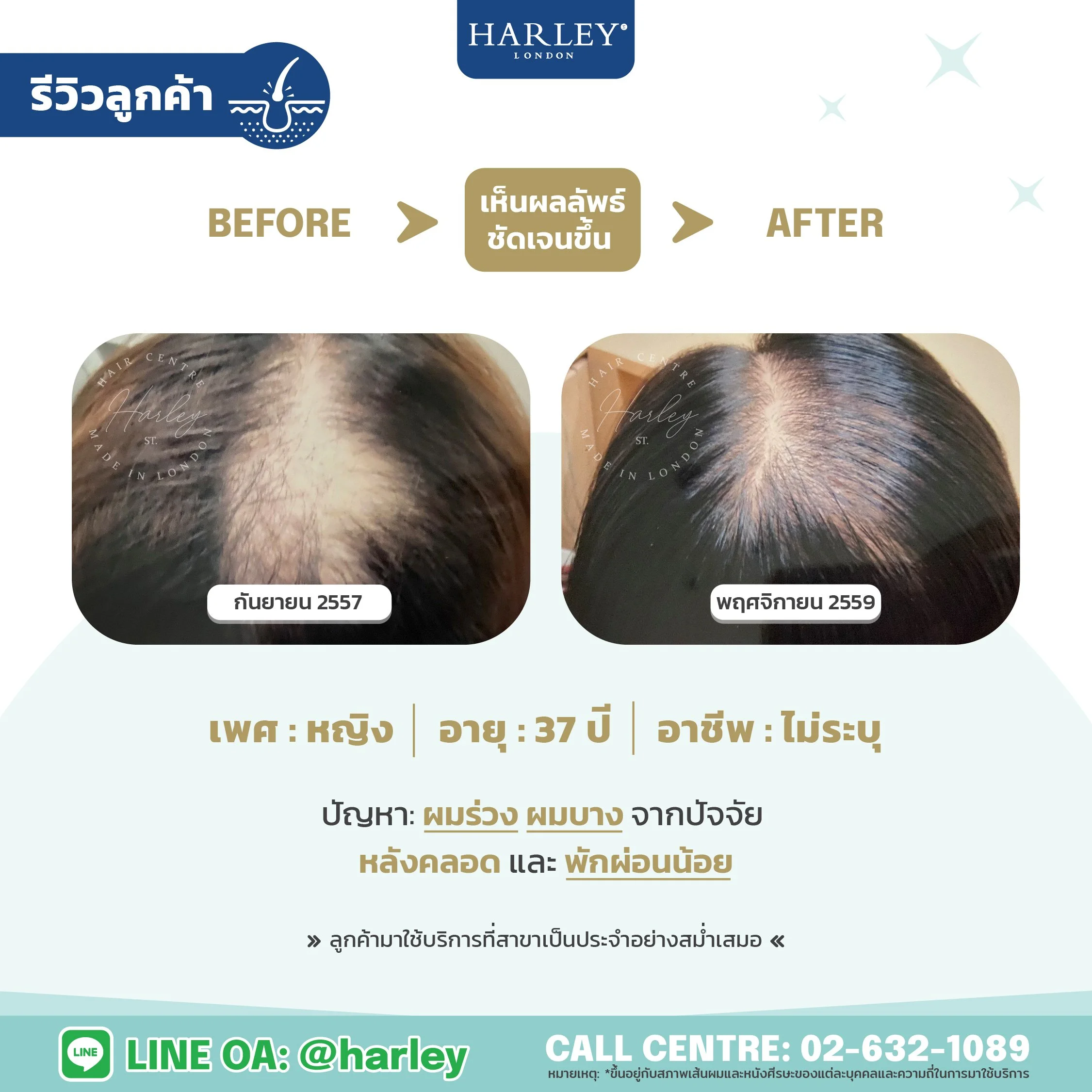 รีวิวลูกค้าหญิง อายุ 37 ปี ผมร่วงผมบางหลังคลอด — Harley St. Hair Centre