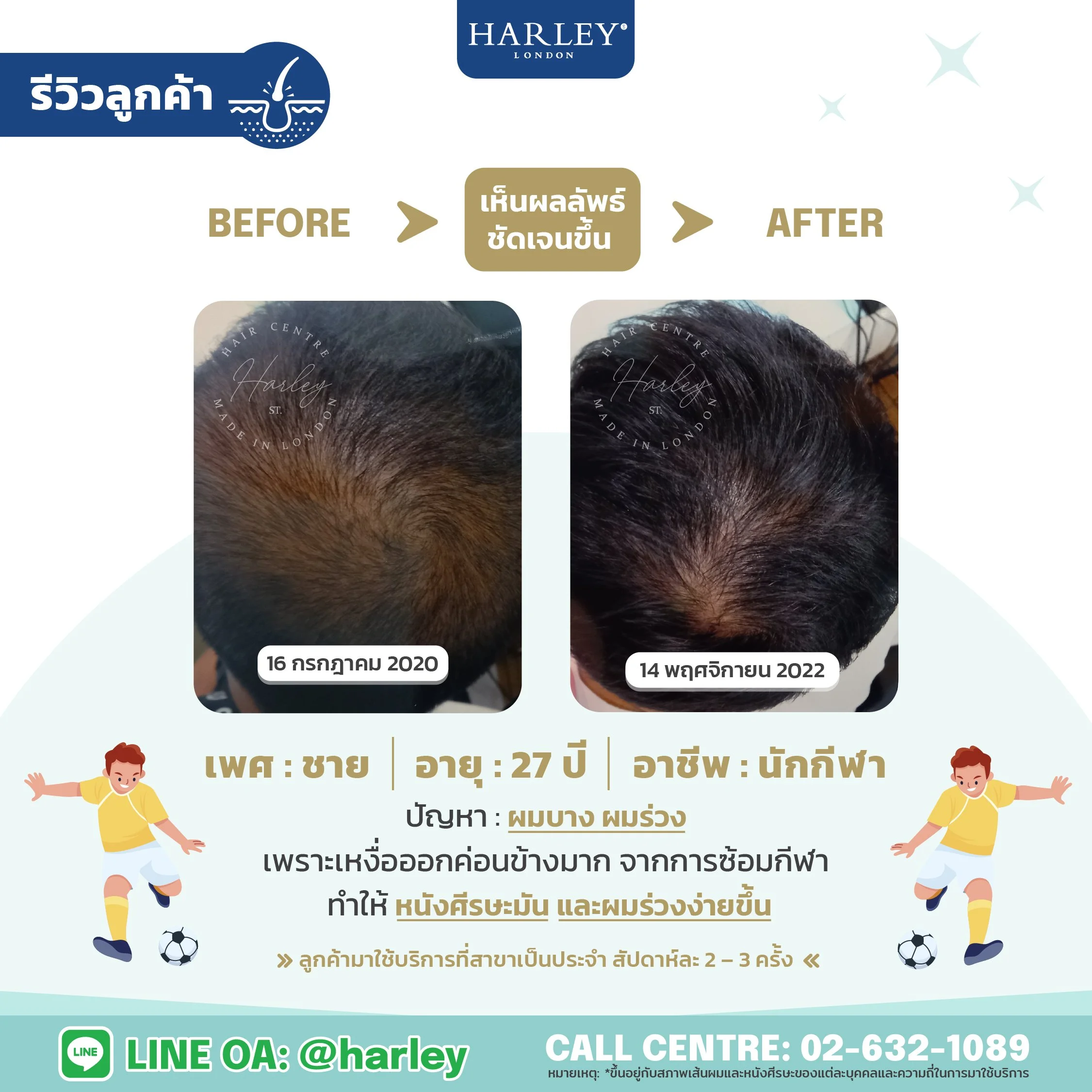 รีวิวลูกค้าชาย อายุ 27 ปี ผมบาง ผมร่วง หนังศีรษะมัน — Harley St. Hair Centre