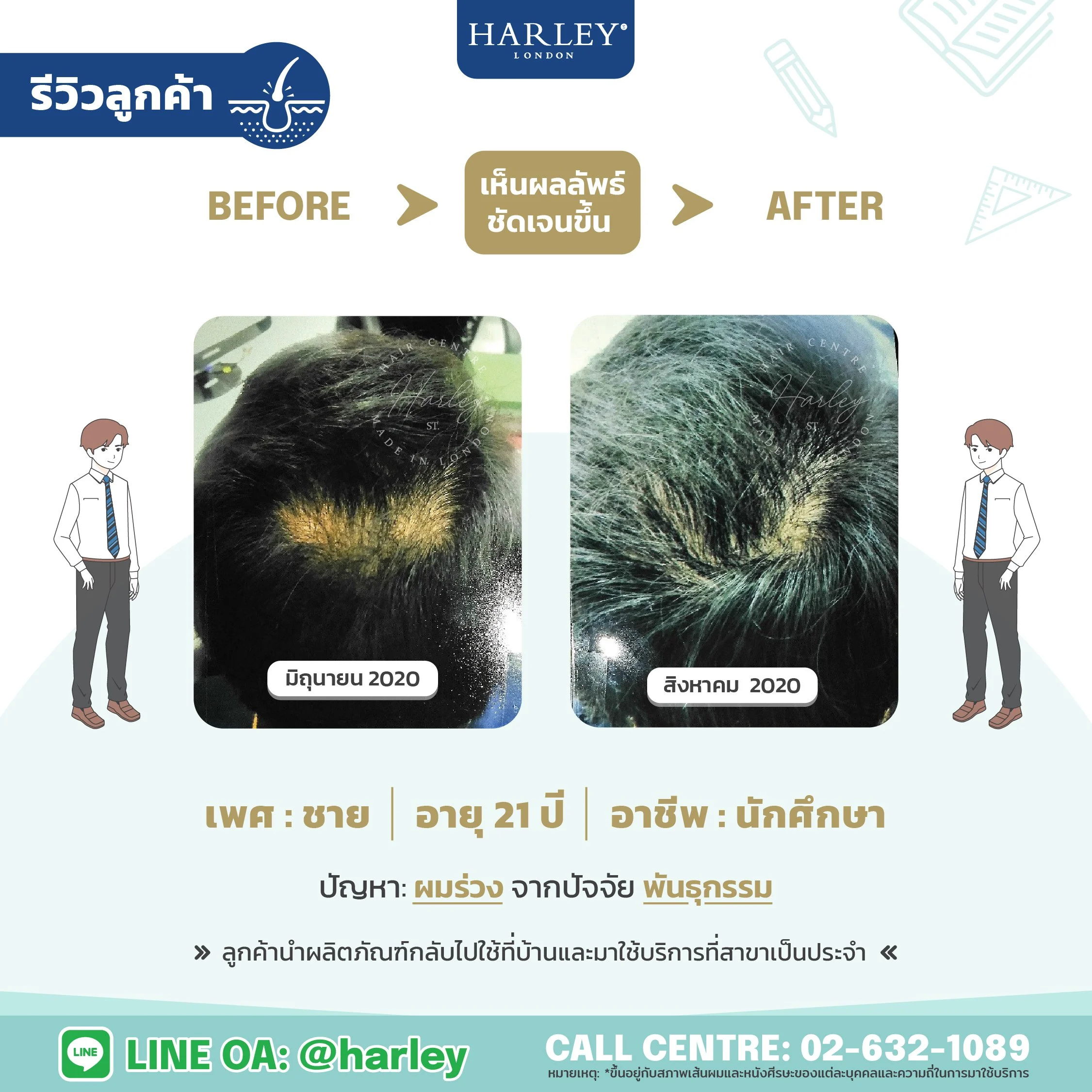 รีวิวลูกค้าชาย อายุ 21 ปี ผมร่วงจากพันธุกรรม — Harley St. Hair Centre