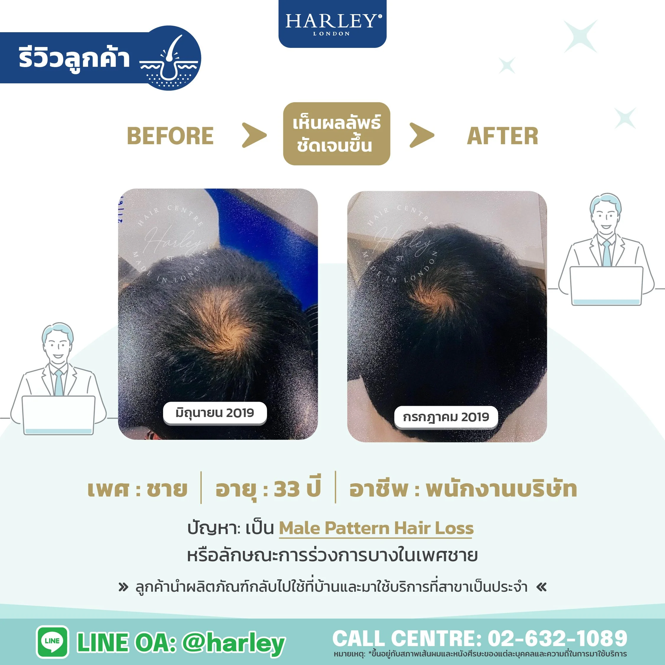 รีวิวลูกค้าชาย อายุ 33 ปี ผมร่วง Male Pattern Hair Loss — Harley St. Hair Centre