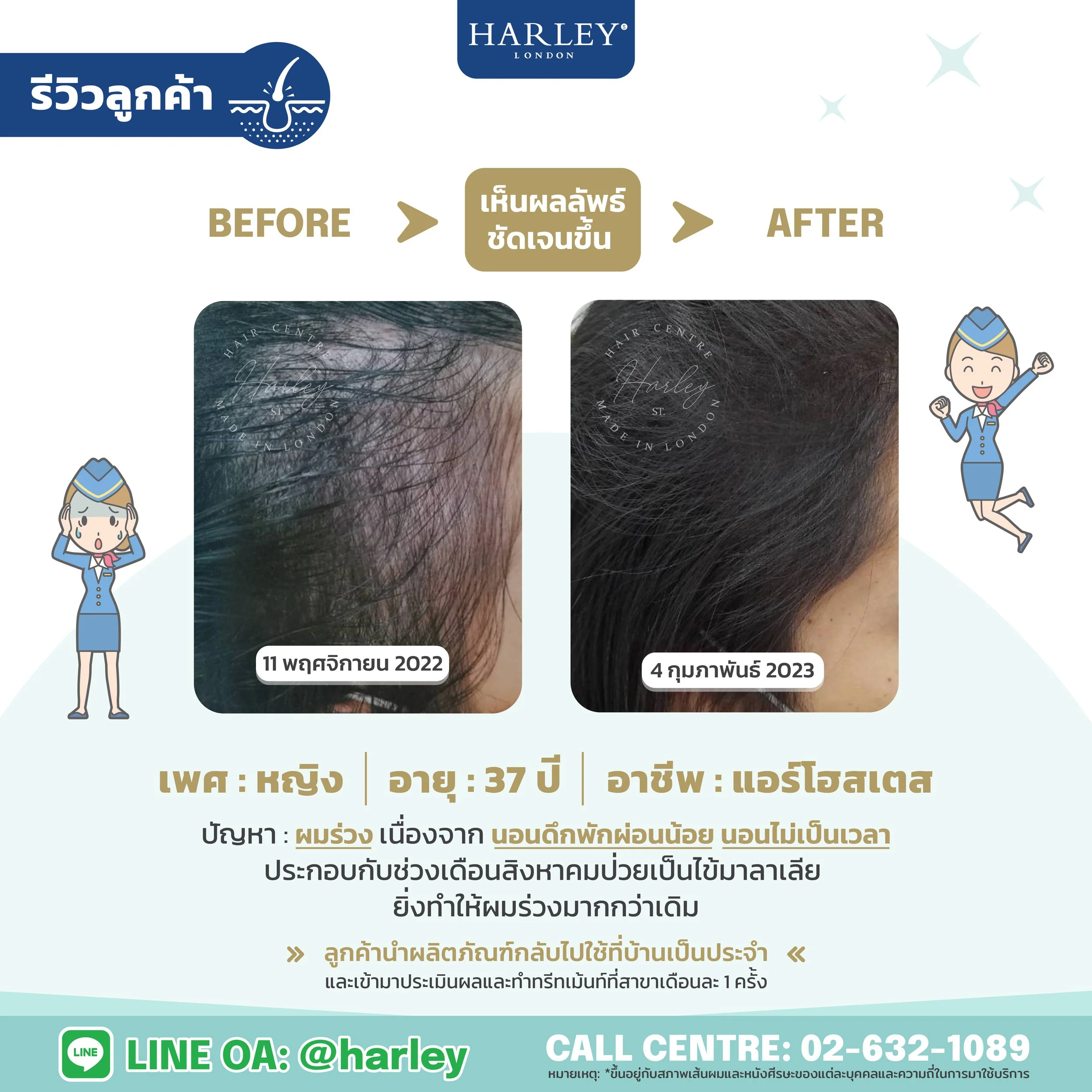 รีวิวลูกค้าหญิง อายุ 37 ปี แอร์โฮสเตส ผมร่วงจากการนอนไม่เป็นเวลา — Harley St. Hair Centre