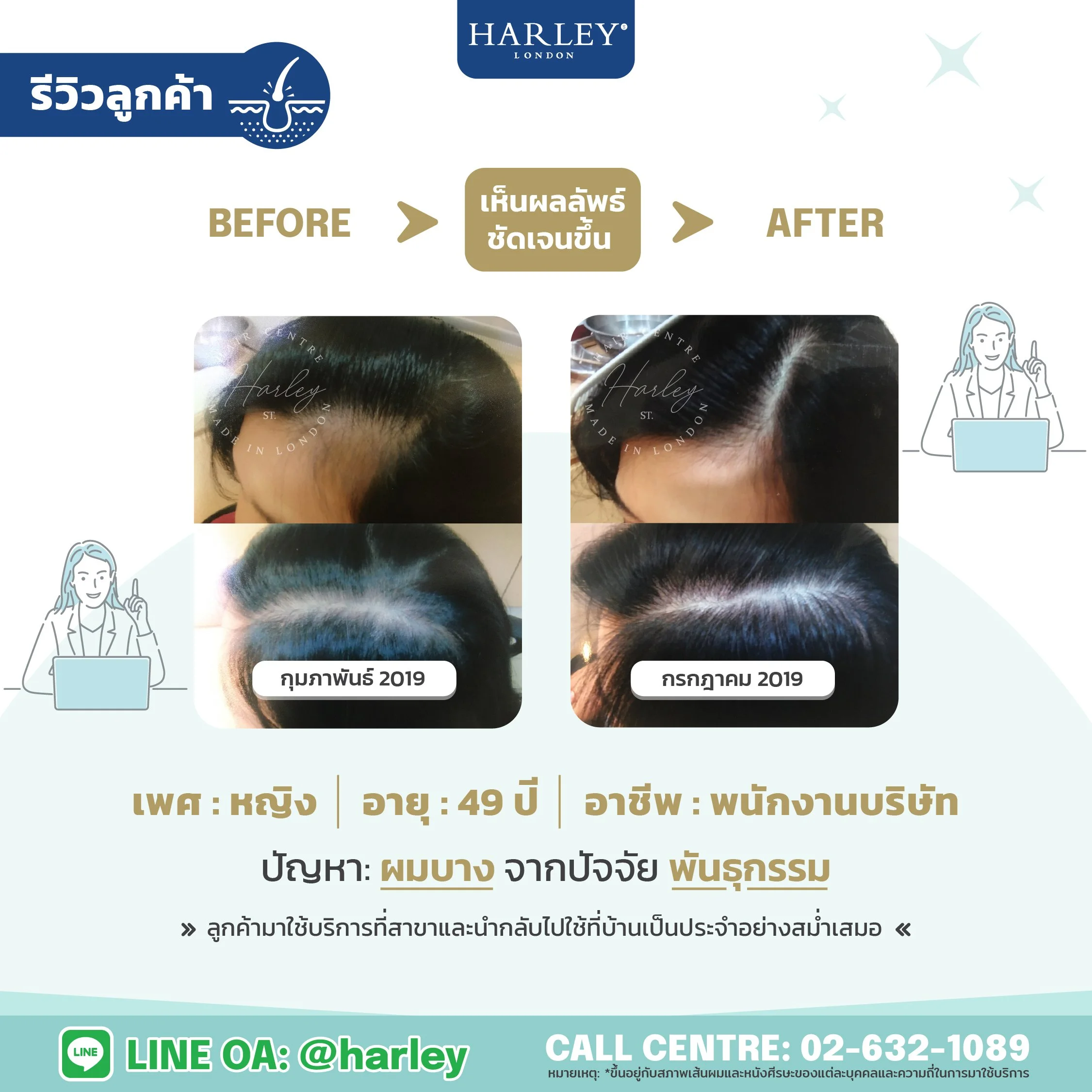รีวิวลูกค้าหญิง อายุ 49 ปี ผมบางจากพันธุกรรม — Harley St. Hair Centre