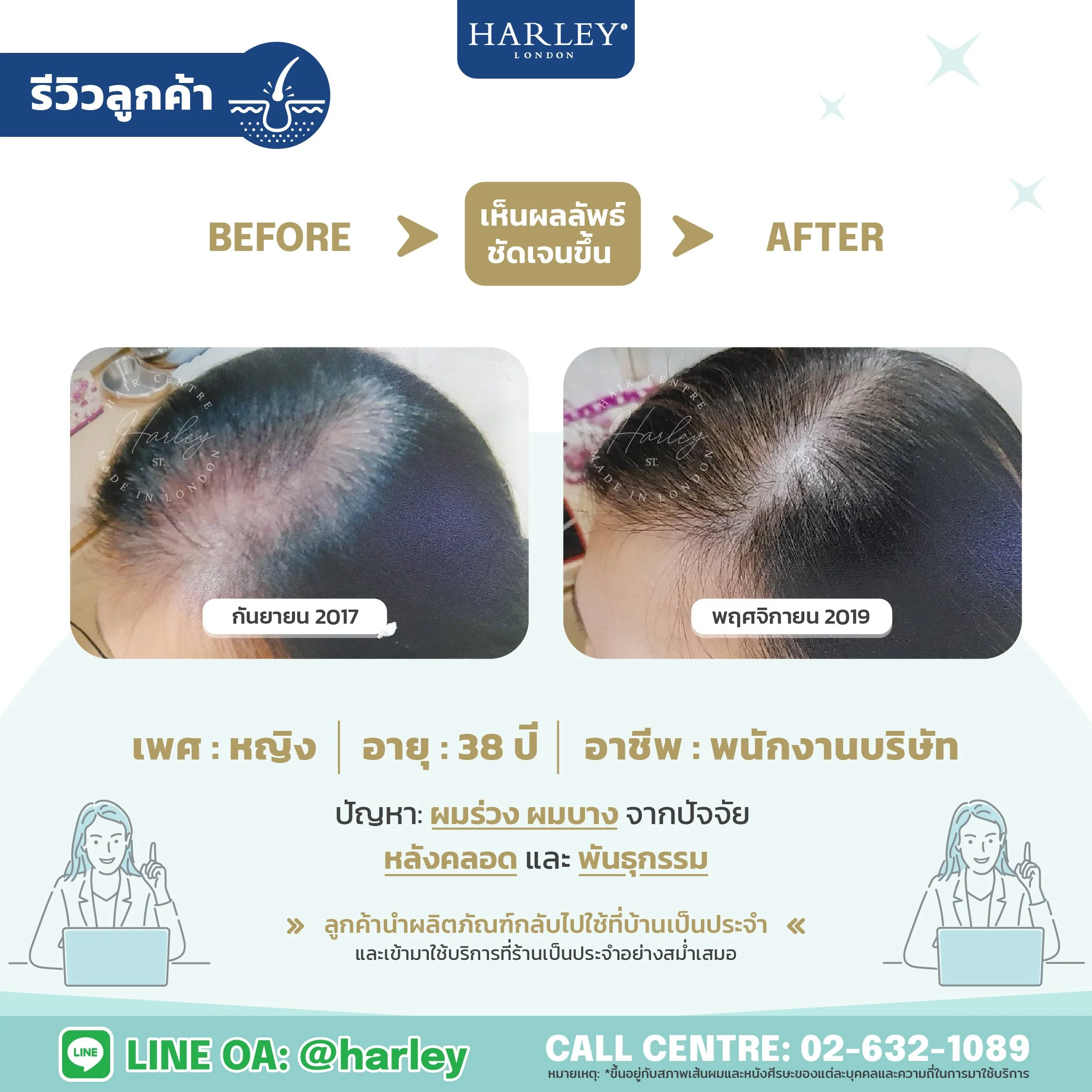 รีวิวลูกค้าหญิง อายุ 38 ปี ผมร่วงผมบางหลังคลอดและพันธุกรรม — Harley St. Hair Centre