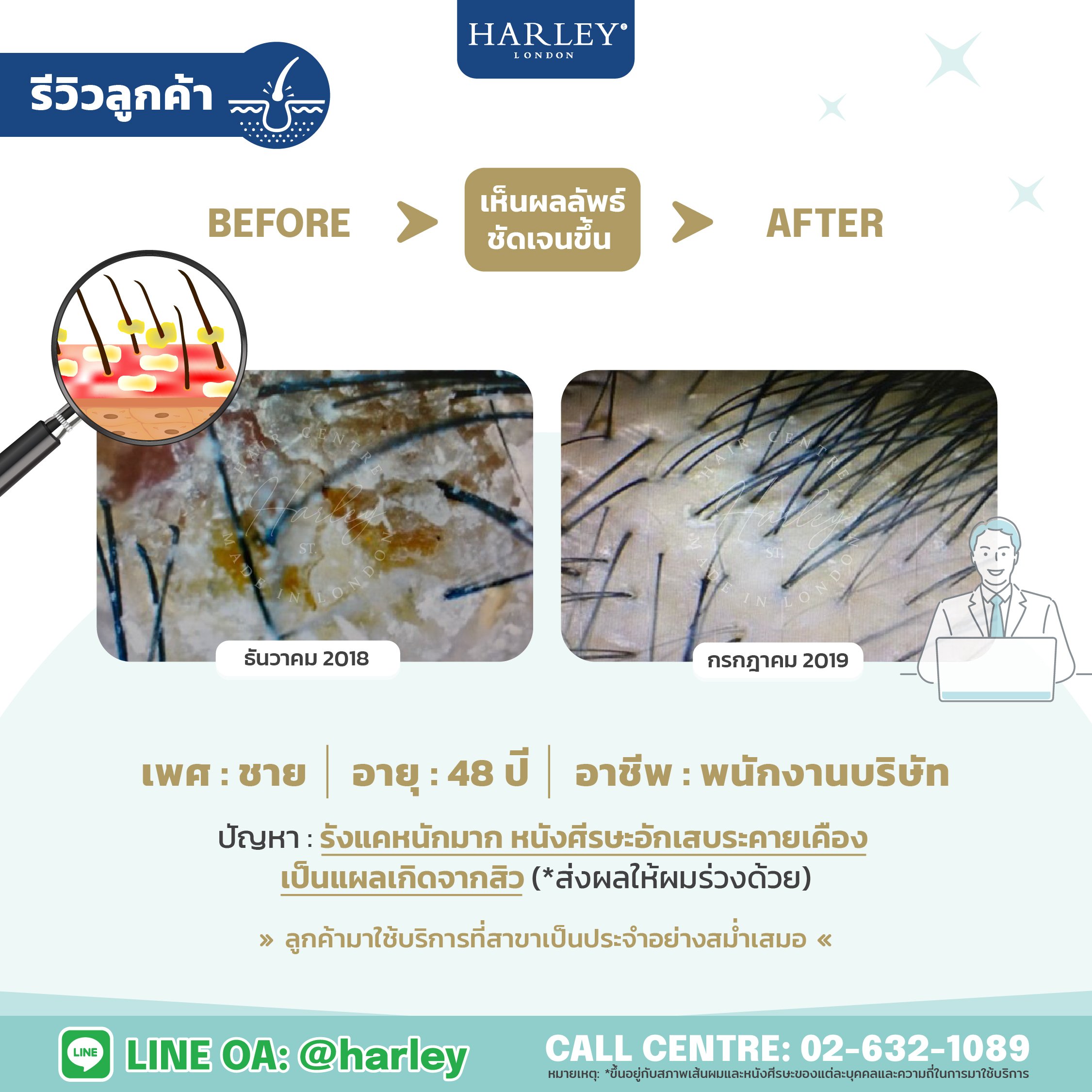 รีวิวลูกค้าชาย อายุ 48 ปี รังแคหนัก หนังศีรษะอักเสบ — Harley St. Hair Centre