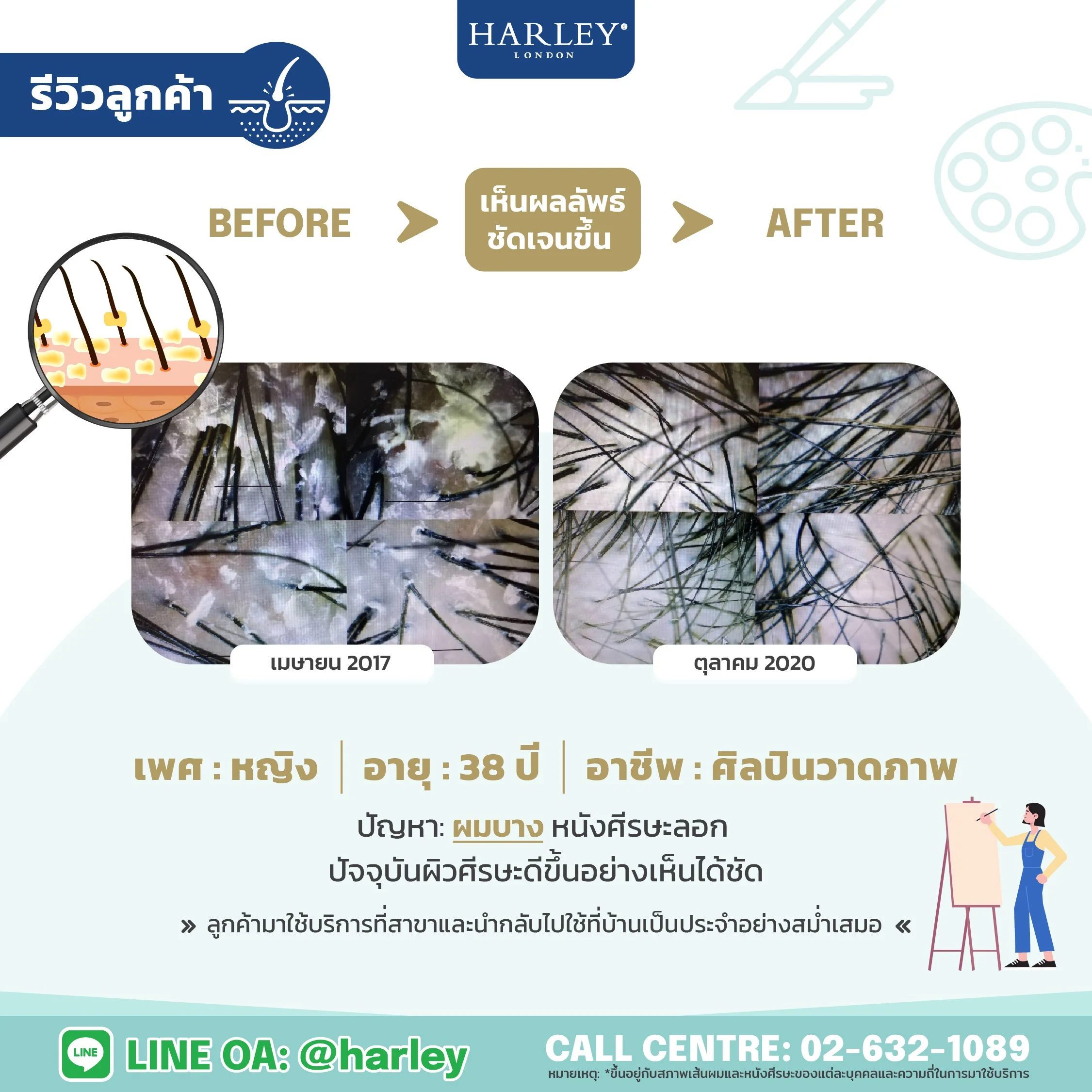 รีวิวลูกค้าหญิง อายุ 38 ปี ผมบาง หนังศีรษะลอก — Harley St. Hair Centre