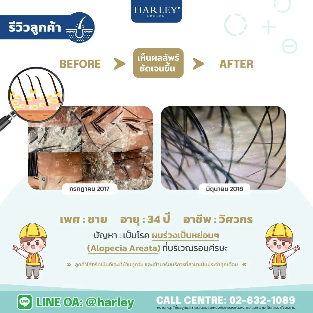 รีวิวลูกค้าชาย อายุ 34 ปี ผมร่วงเป็นหย่อม Alopecia Areata — Harley St. Hair Centre