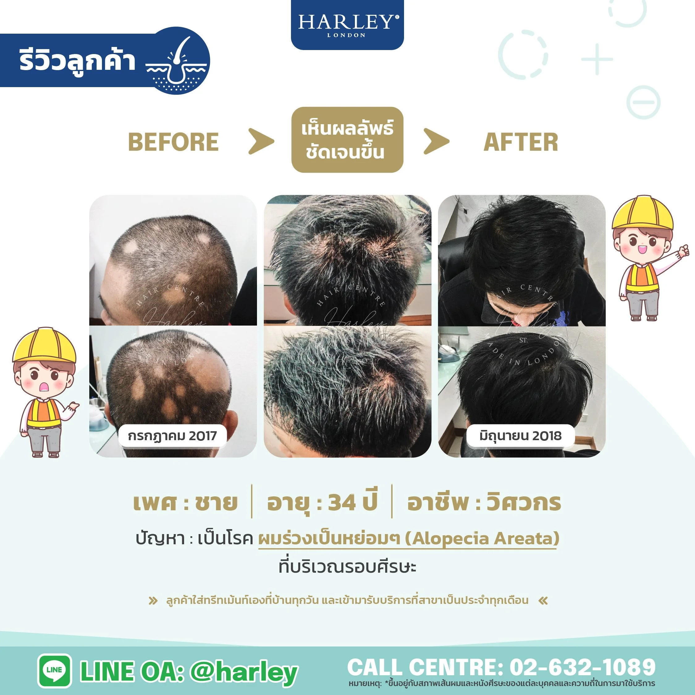 รีวิวลูกค้าชาย อายุ 34 ปี ผมร่วงเป็นหย่อม Alopecia Areata ทั่วศีรษะ — Harley St. Hair Centre