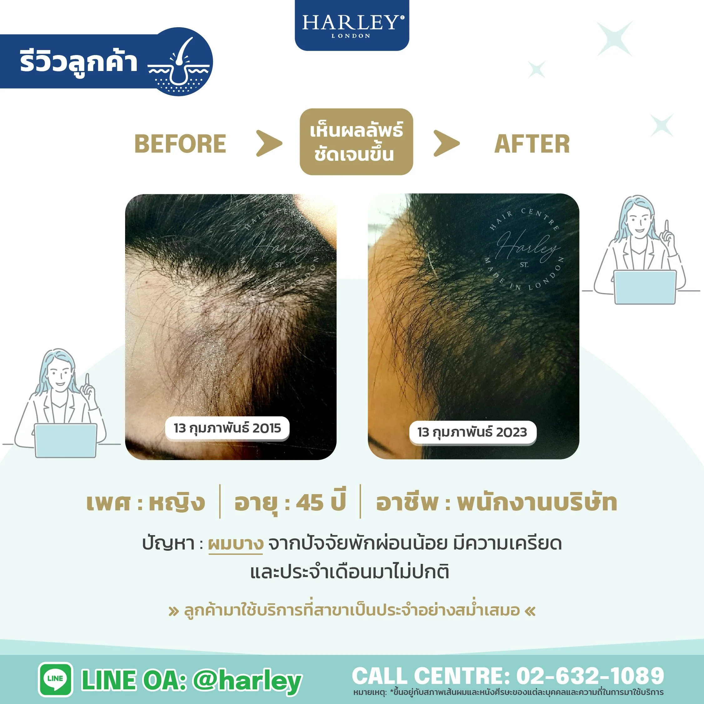 รีวิวลูกค้าหญิง อายุ 45 ปี ผมบางจากฮอร์โมนและพักผ่อนน้อย — Harley St. Hair Centre
