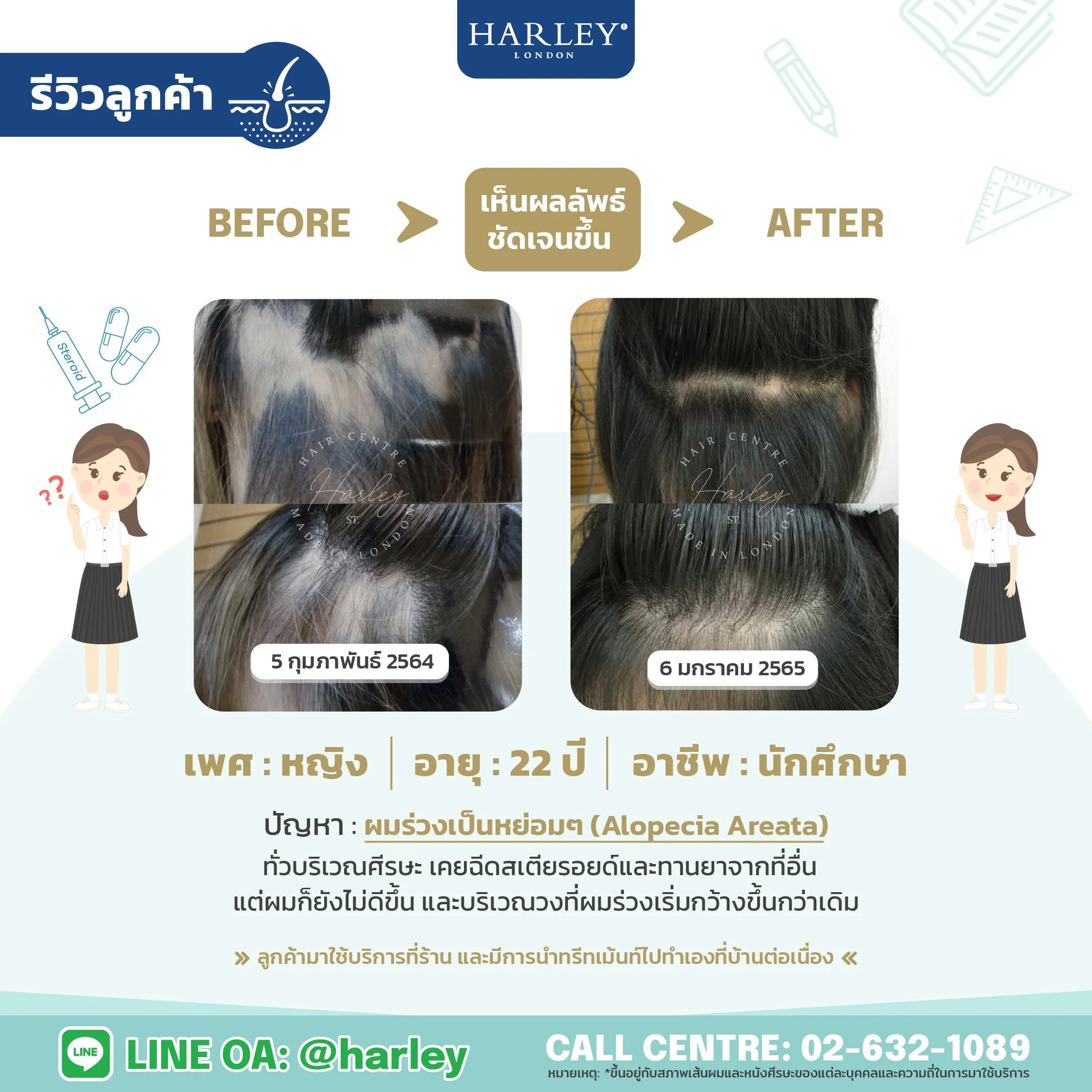 รีวิวลูกค้าหญิง อายุ 22 ปี ผมร่วงเป็นหย่อม Alopecia Areata ทั่วศีรษะ — Harley St. Hair Centre