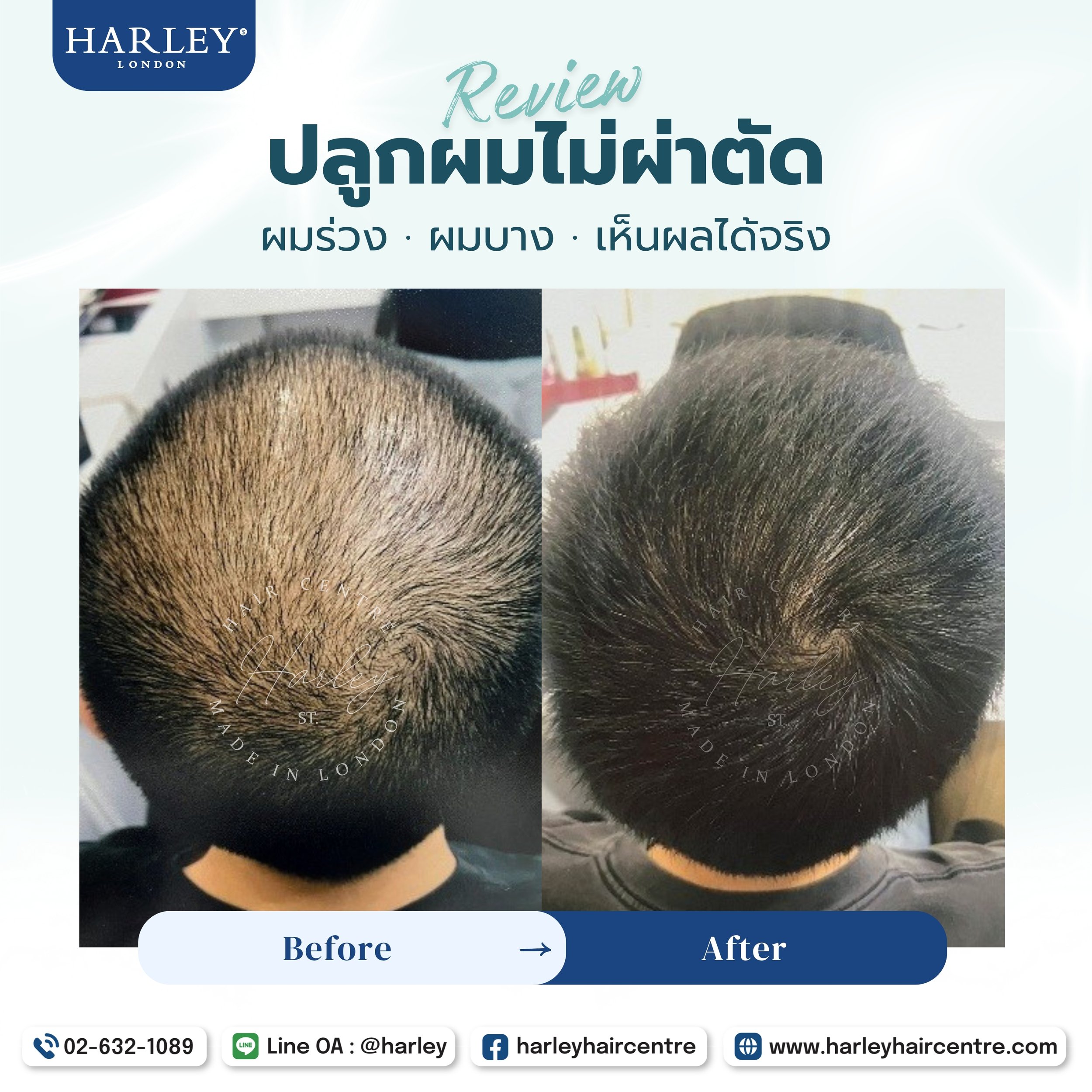 ผมร่วง ผมบาง ไม่ต้องผ่าตัด — Harley St. Hair Centre ดูแลคุณได้อย่างปลอดภัยและเห็นผลจริง
