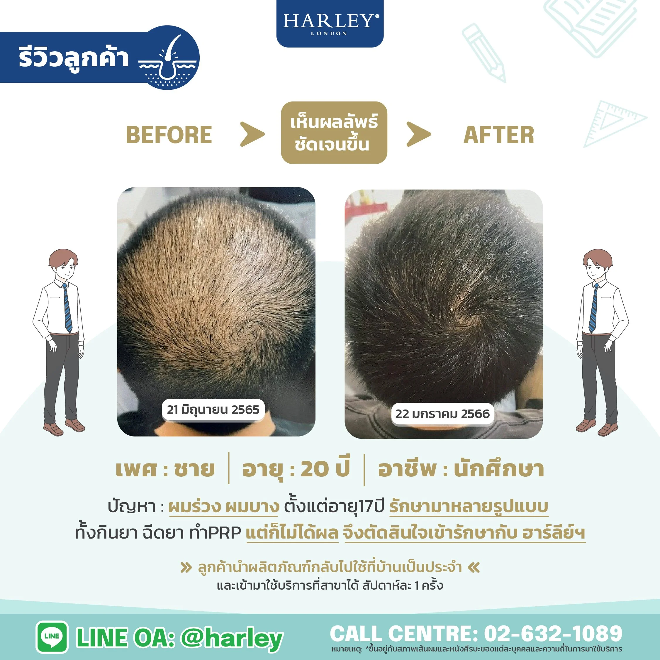 รีวิวลูกค้าชาย อายุ 20 ปี ผมร่วงผมบางตั้งแต่ 17 ปี รักษามาหลายวิธีไม่ได้ผล — Harley St. Hair Centre