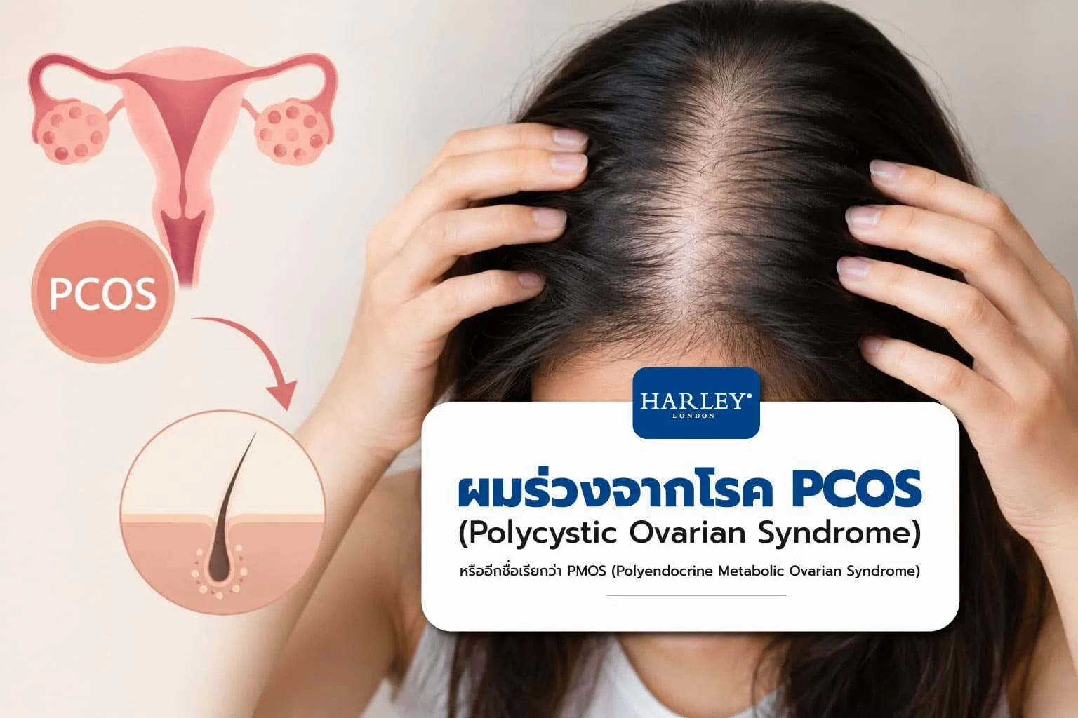 ผมร่วงจาก PCOS (หรือชื่อใหม่ PMOS) เกิดจากอะไร? เจาะลึกกลไกลฮอร์โมนแอนโดรเจนที่ทำให้ผมบาง พร้อมอัพเดทแนวทางดูแลล่าสุดปี  2026