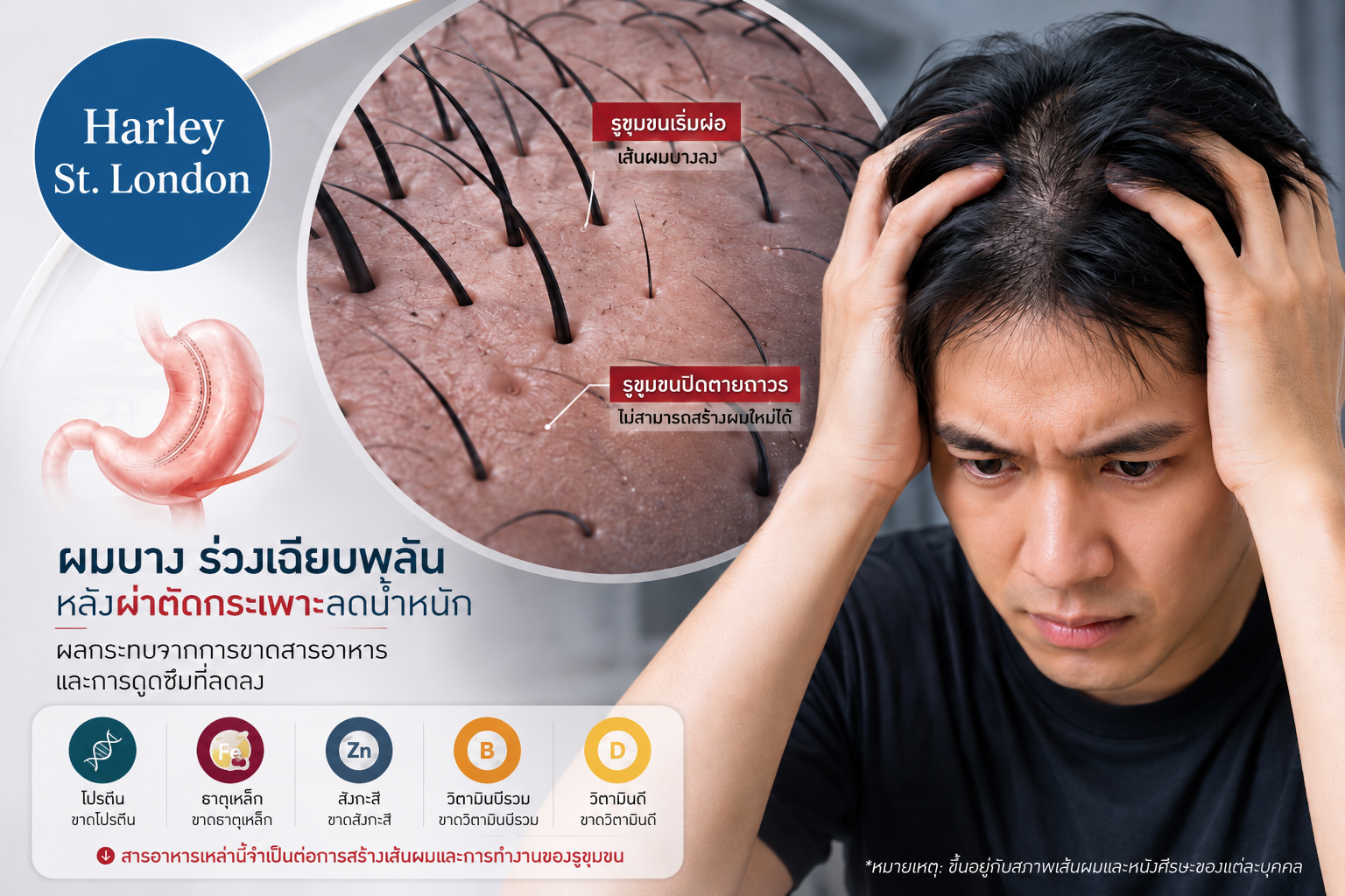ราคาที่ต้องจ่ายหลังหุ่นสับ: เจาะลึกปัญหาผมร่วง-ผมบางจากการผ่าตัดกระเพาะลดน้ำหนัก (Bariatric Surgery) เทรนด์มาแรงในไทยที่มาพร้อมความเสี่ยง