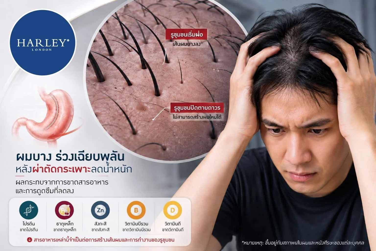 ราคาที่ต้องจ่ายหลังหุ่นสับ: เจาะลึกปัญหาผมร่วง-ผมบางจากการผ่าตัดกระเพาะลดน้ำหนัก (Bariatric Surgery) เทรนด์มาแรงในไทยที่มาพร้อมความเสี่ยง