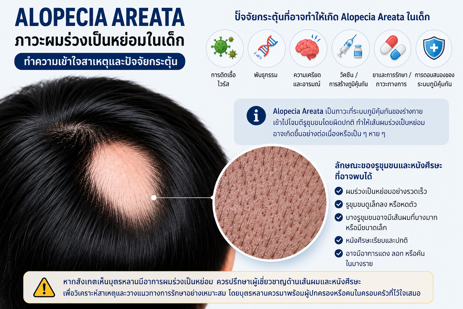 โรคผมร่วงเป็นหย่อมในเด็ก: ปัจจัยกระตุ้นจากการอักเสบที่ซ่อนอยู่ อันตรายจากสเตียรอยด์ และทางออกที่ปลอดภัยโดยผู้เชี่ยวชาญด้านเส้นผมและหนังศีรษะ (Hair and Scalp Specialist)
