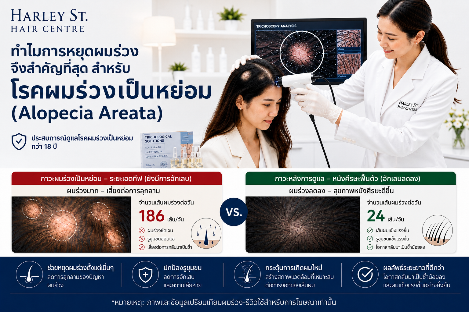 อันตรายจากการเร่งปลูกผม: ทำไมการควบคุมปัญหาผมร่วงจึงต้องมาก่อนเป็นอันดับแรกในภาวะผมร่วงเป็นหย่อม (Alopecia Areata)