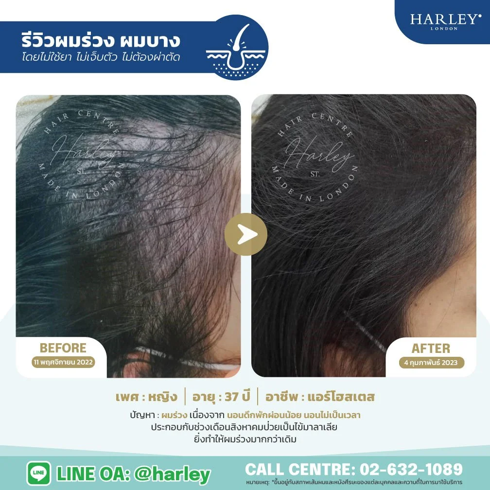 รีวิวฟื้นฟูผมร่วงผมบาง หญิงอายุ 37 ปี Harley St. Hair Centre สาขาลาดพร้าว 15 ปรับสมดุลหนังศีรษะให้ผมกลับมาหนานุ่ม