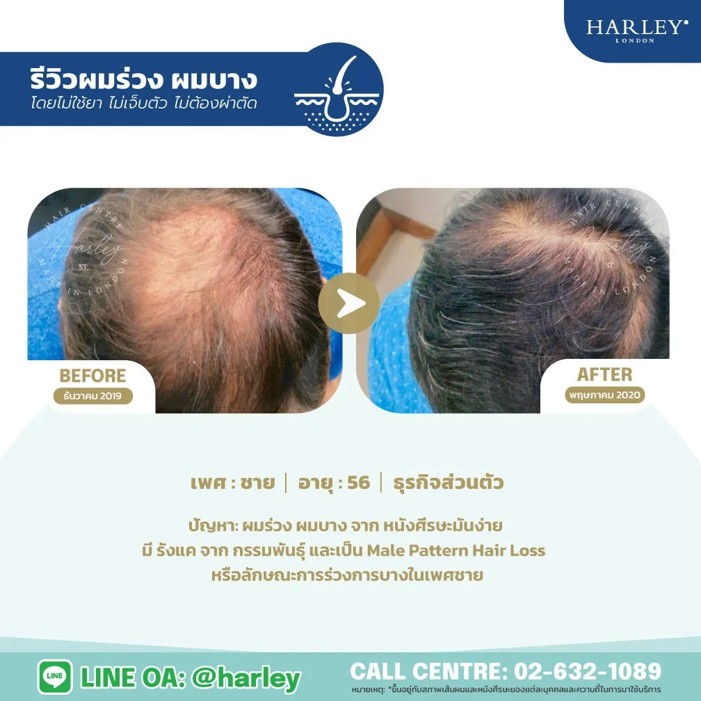 รีวิวแก้ปัญหาผมร่วงผมบางกลางศีรษะจากกรรมพันธุ์ ชาย 56 ปี Harley St. Hair Centre สาขาบางนา
