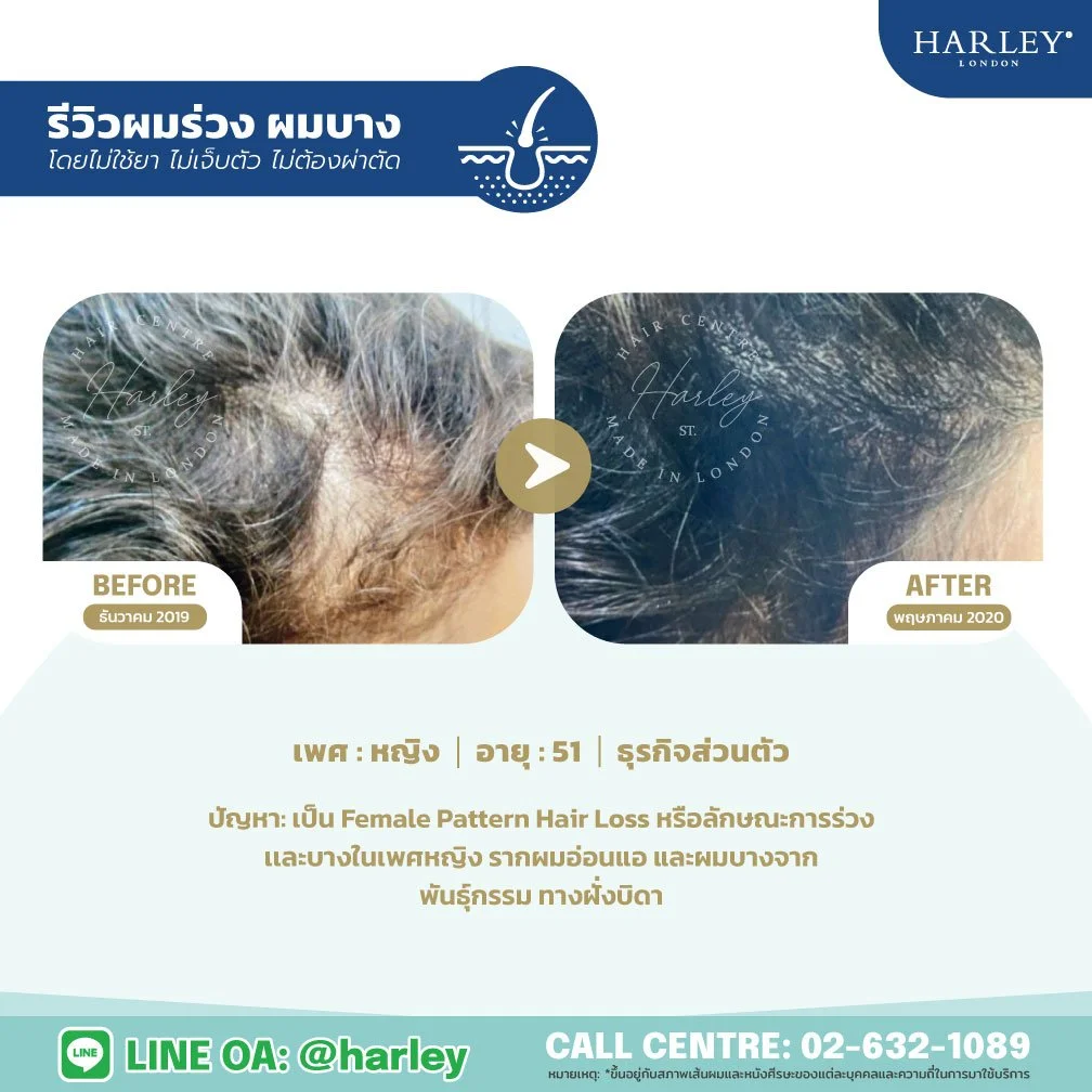 รีวิวแก้ปัญหา Female Pattern Hair Loss รากผมอ่อนแอ หญิง 51 ปี Harley St. Hair Centre สาขาบางนา