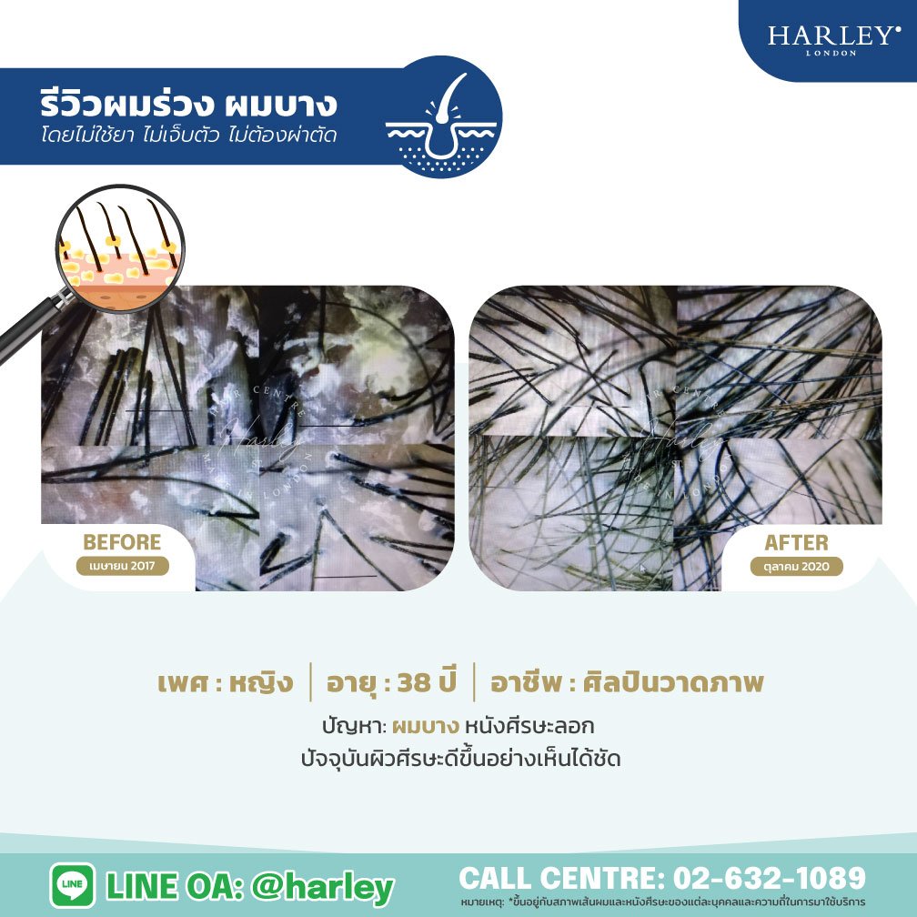 ภาพเปรียบเทียบผลลัพธ์จากการสแกนเช็คสภาวะหนังศีรษะและรากผม ก่อนและหลังการฟื้นฟูเคสผู้หญิงอายุ 38 ปี อาชีพศิลปินวาดภาพ ปัญหาผมบาง หนังศีรษะลอก โดย Harley St. Hair Centre สาขาอาคาร ITF สีลมพาเลส