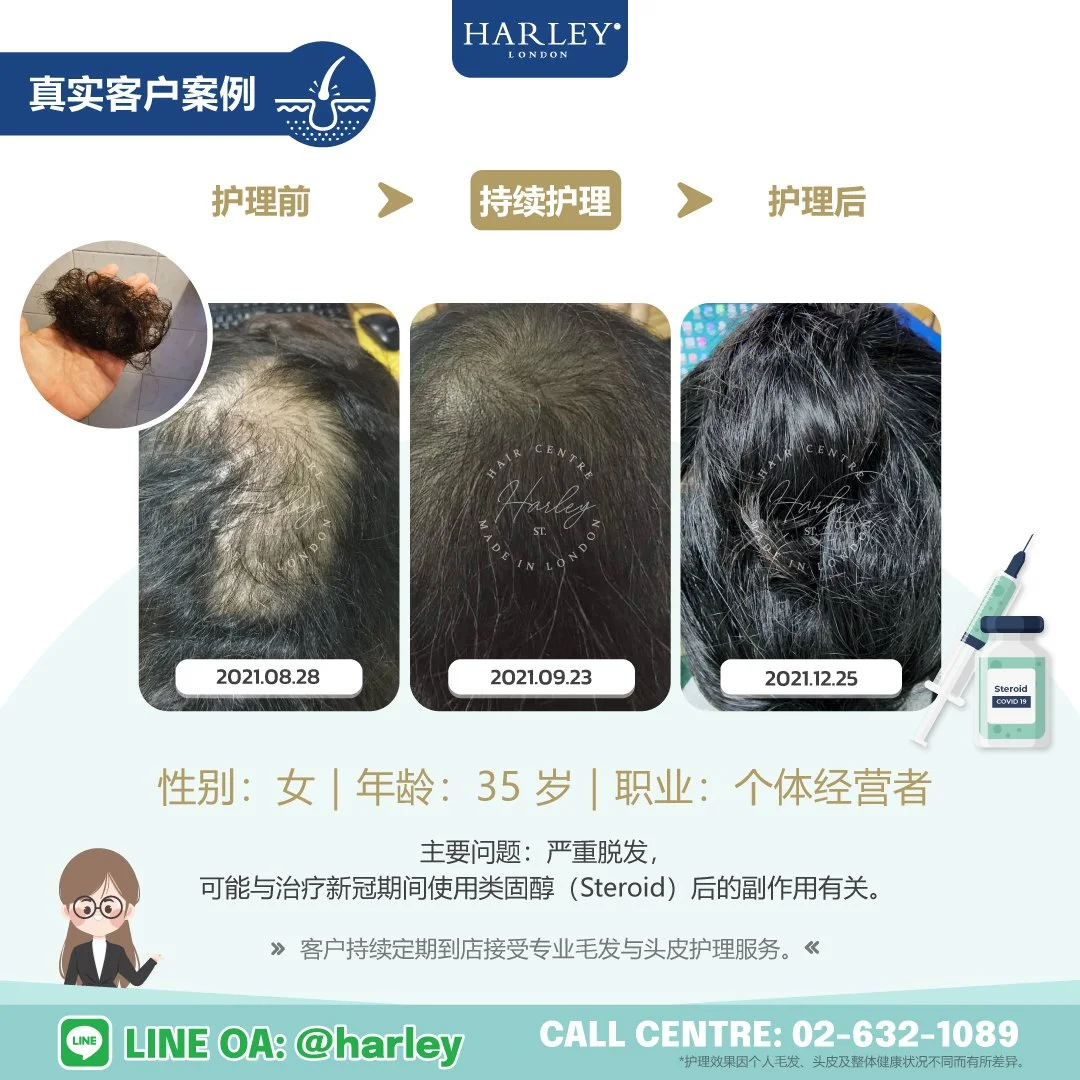 真实客户护理案例：35 岁女性，出现严重脱发，可能与治疗新冠期间使用类固醇（Steroid）后的副作用有关。展示 Harley St. Hair Centre 专业毛发与头皮护理前后的变化。