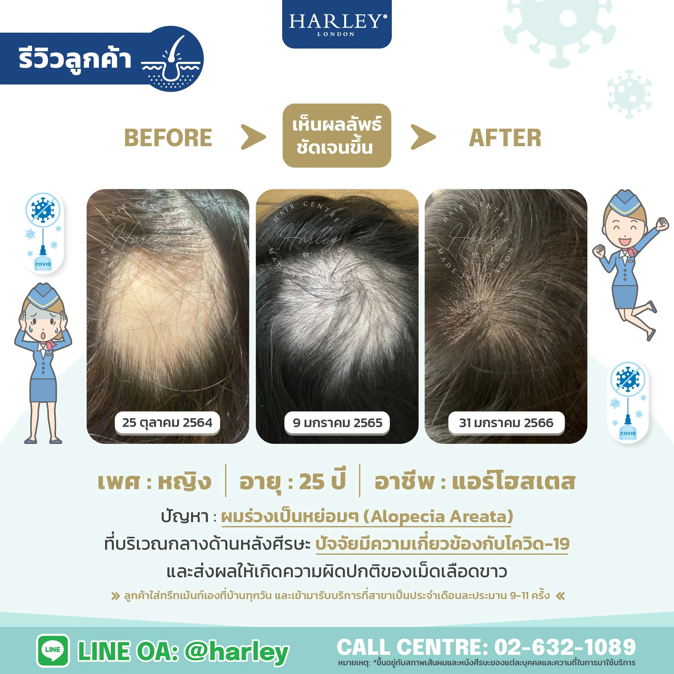 รีวิวลูกค้าเพศหญิงอายุ 25 ปี ผมร่วงเป็นหย่อมๆจากโควิด 19