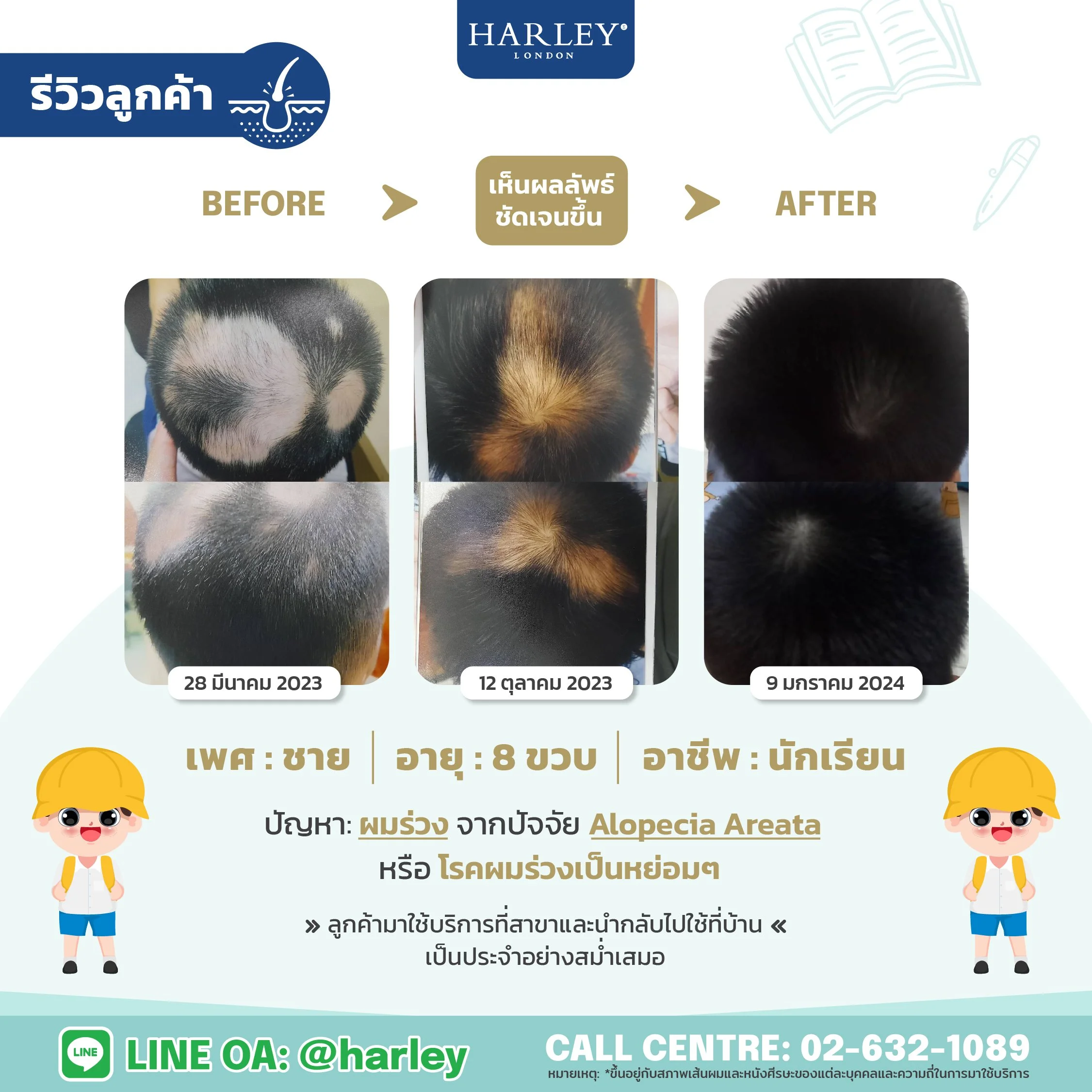 ภาพเปรียบเทียบก่อนและหลังการรักษาผมร่วงในเด็กชาย แสดงให้เห็นถึงความเปลี่ยนแปลงที่ดีขึ้นเมื่อเวลาผ่านไปหลังรักษาผมร่วงที่ Harley St. Hair Centre แสดงให้เห็นถึงจำนวนผมที่หนาแน่นขึ้นอย่างชัดเจน