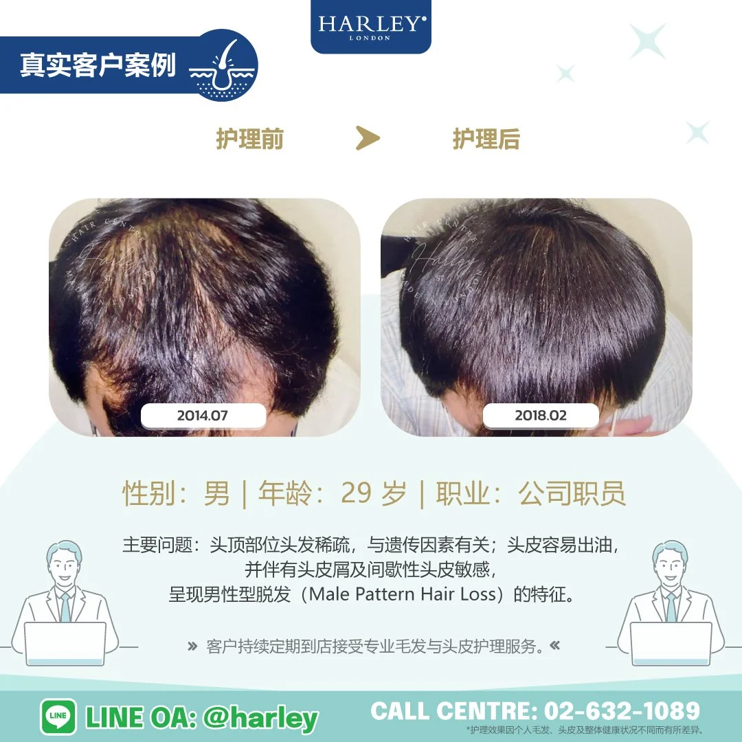 真实男性客户护理案例，记录头顶部位头发稀疏的护理前后变化。客户头发稀疏与遗传因素有关，并伴有油性头皮、头皮屑及间歇性头皮敏感，呈现男性型脱发（Male Pattern Hair Loss）的特征。客户持续定期到店接受专业毛发与头皮护理。护理效果因个人毛发、头皮及整体健康状况不同而有所差异。