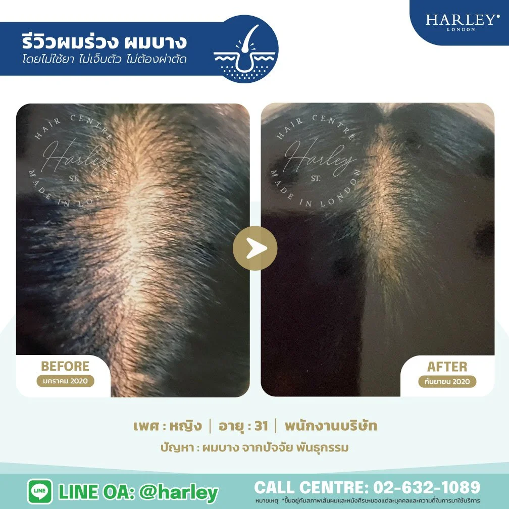 รีวิวฟื้นฟูผมบางกลางศีรษะจากกรรมพันธุ์ หญิง 31 ปี Harley St. Hair Centre สาขาบางนา