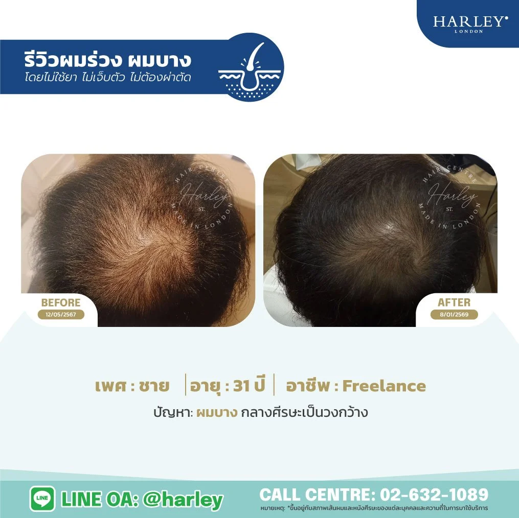 ภาพเปรียบเทียบผลลัพธ์ก่อนและหลังการดูแลฟื้นฟูสภาวะผมบางกลางศีรษะเป็นวงกว้าง เคสชายอายุ 31 ปี อาชีพ Freelance โดย Harley St. Hair Centre สาขาอาคาร ITF สีลมพาเลส ติดถนนนราธิวาสฯ แบบไม่ใช้ยา ไม่ผ่าตัด