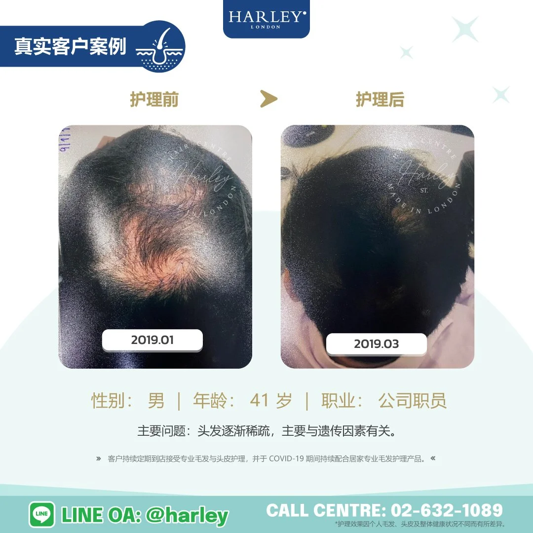 Harley St. Hair Centre Ladprao 真实客户护理案例，41 岁男性因遗传因素导致头发稀疏，经过专业毛发与头皮护理后，头顶部位毛发状况有所改善。