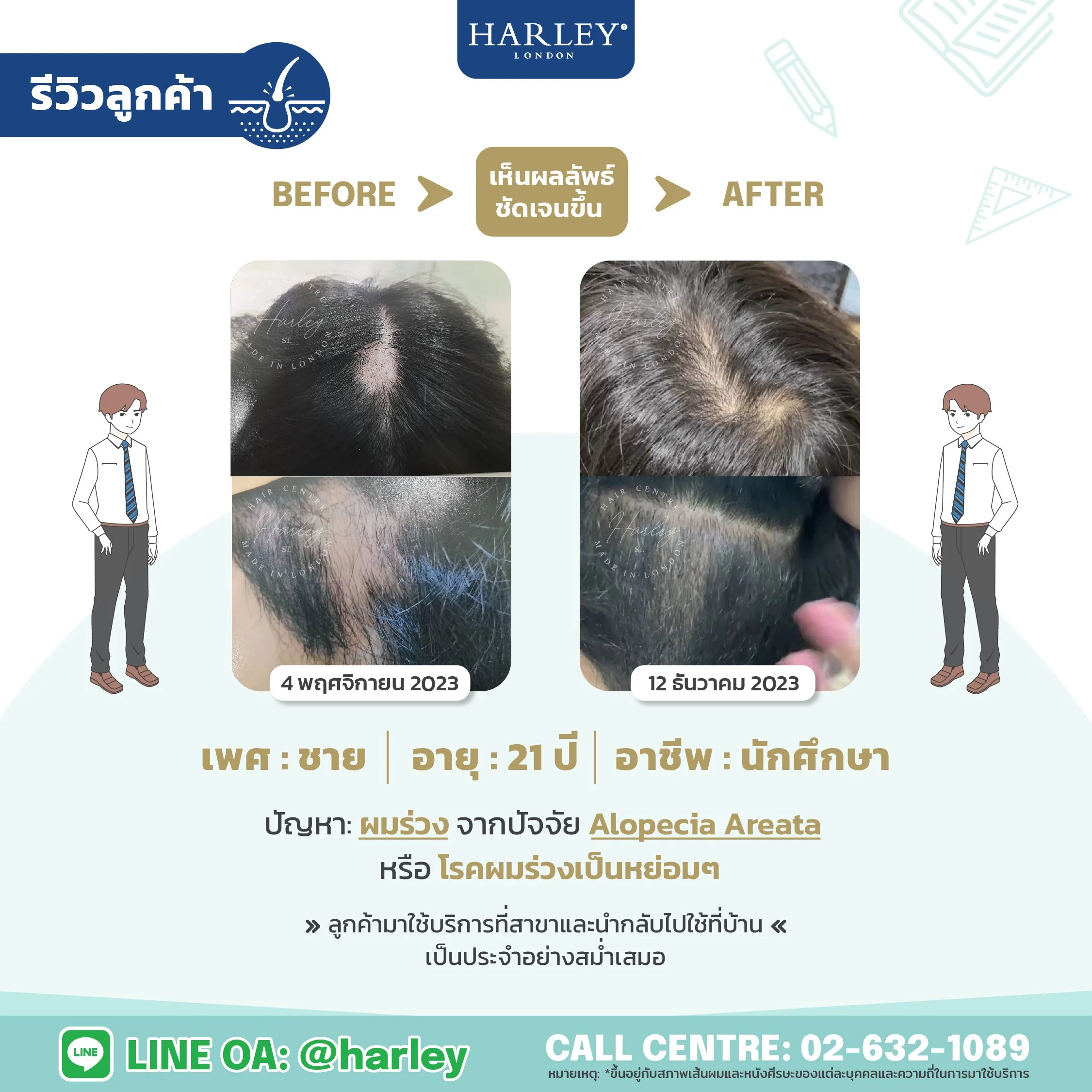 รีวิวลูกค้าเพศชายอายุ 21 ปี ผมร่วงเป็นหย่อมๆ Alopecia Areata