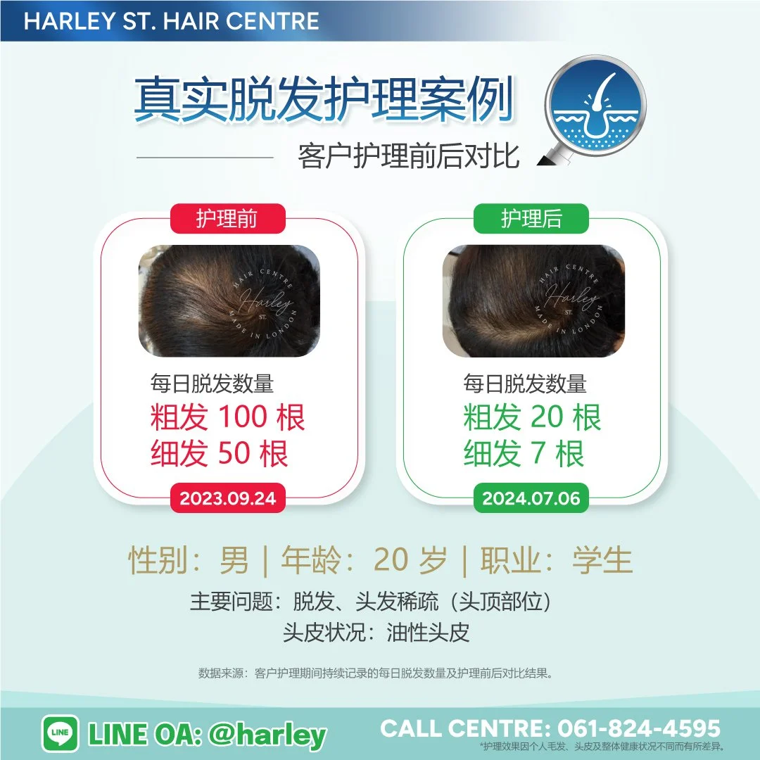 男性真实脱发护理案例，展示护理前后每日脱发数量变化，改善头顶部位头发稀疏及油性头皮。