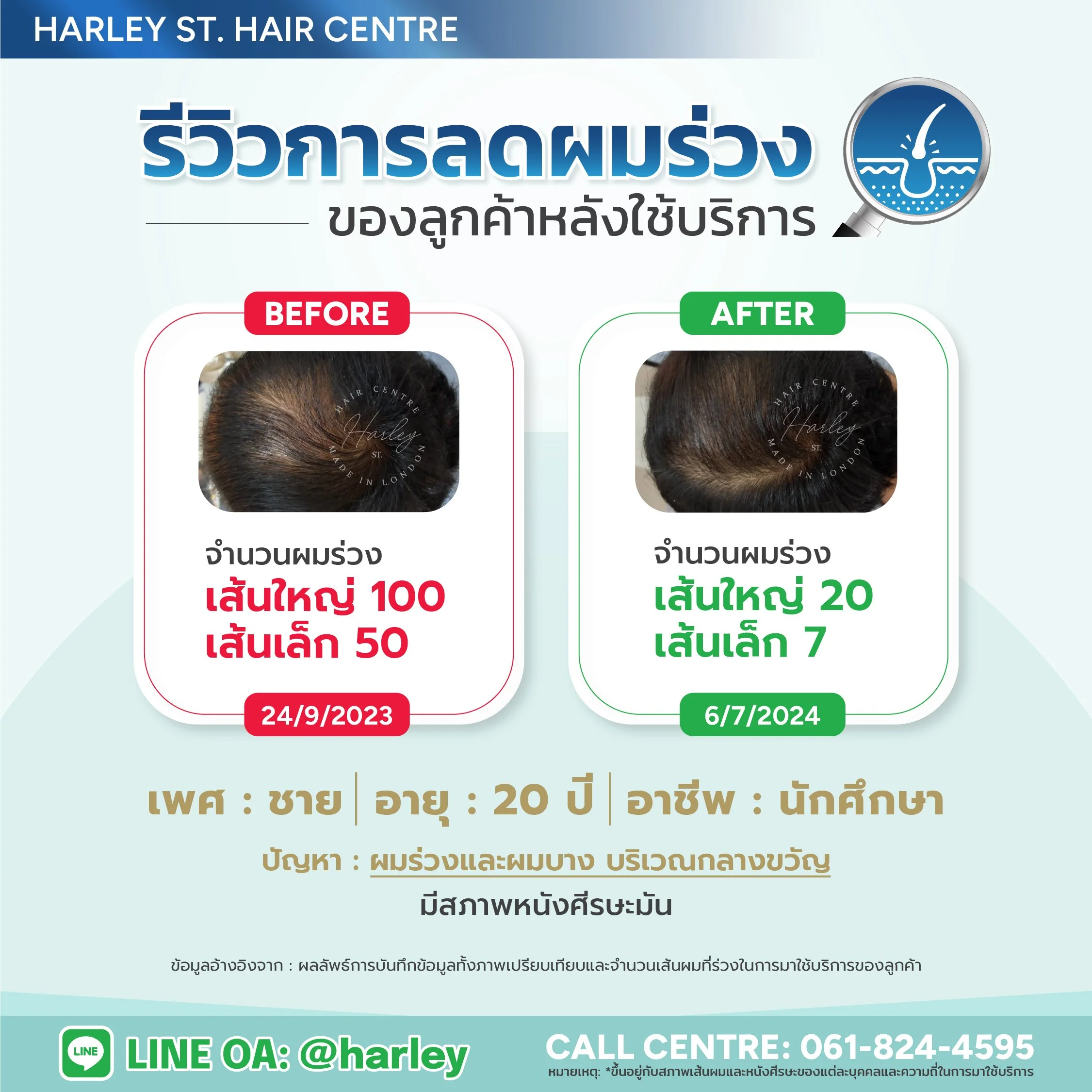 ภาพแสดงให้เห็นถึงการเปรียบเทียบก่อนและหลังรักษาผมร่วง ผมบาง ของเพศชาย อายุ 20 ปี ก่อนเข้าดูแลผมร่วงผิดปกติ 150 กว่าเส้นทุกวันจนผมเริ่มบางลงอย่างเห็นได้ชัด ปัจจุบันผมร่วงลดน้อยลงเหลือ 27 เส้นต่อวัน