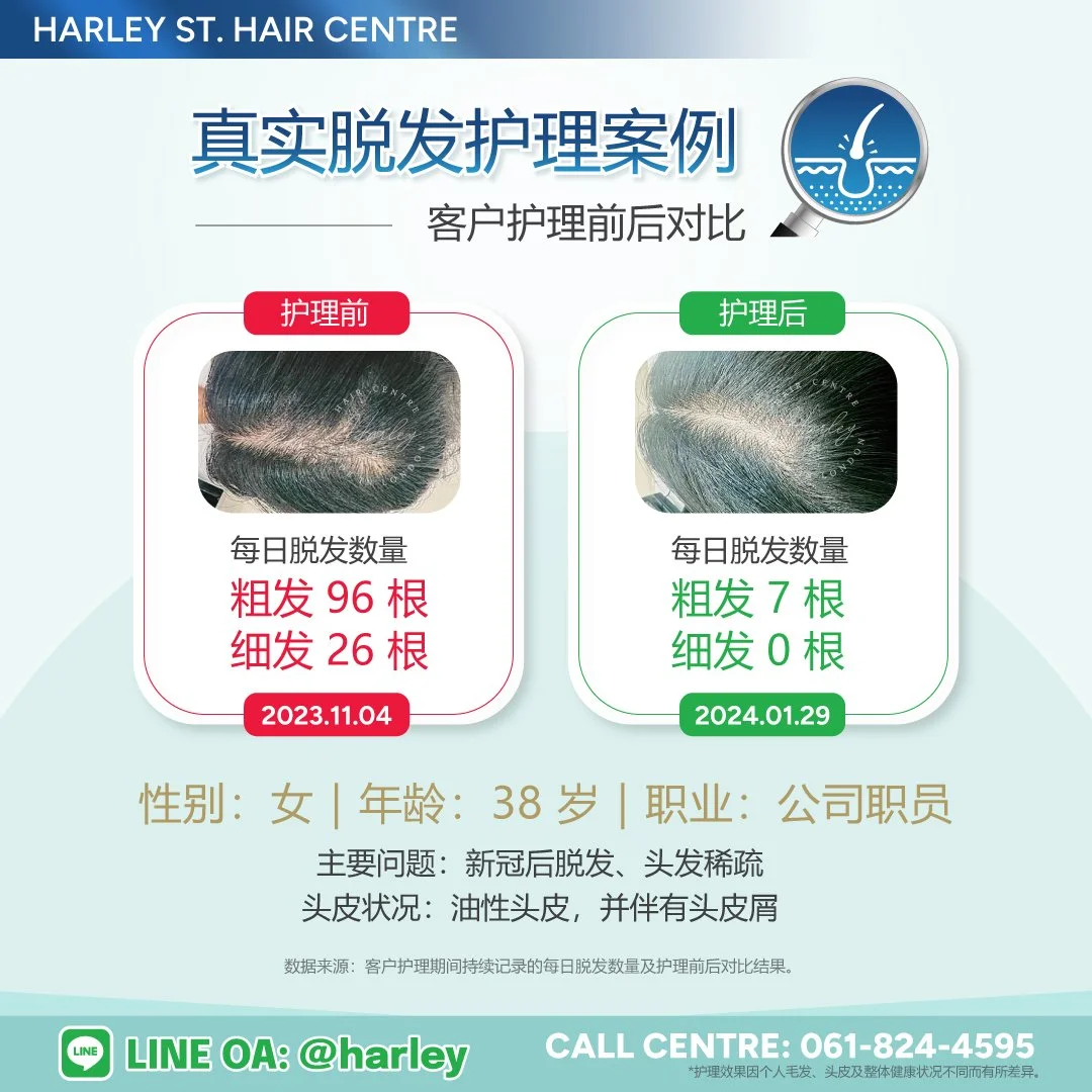 真实女性脱发护理案例，对比新冠后脱发护理前后每日脱发数量变化，改善头发稀疏、油性头皮及头皮屑问题。