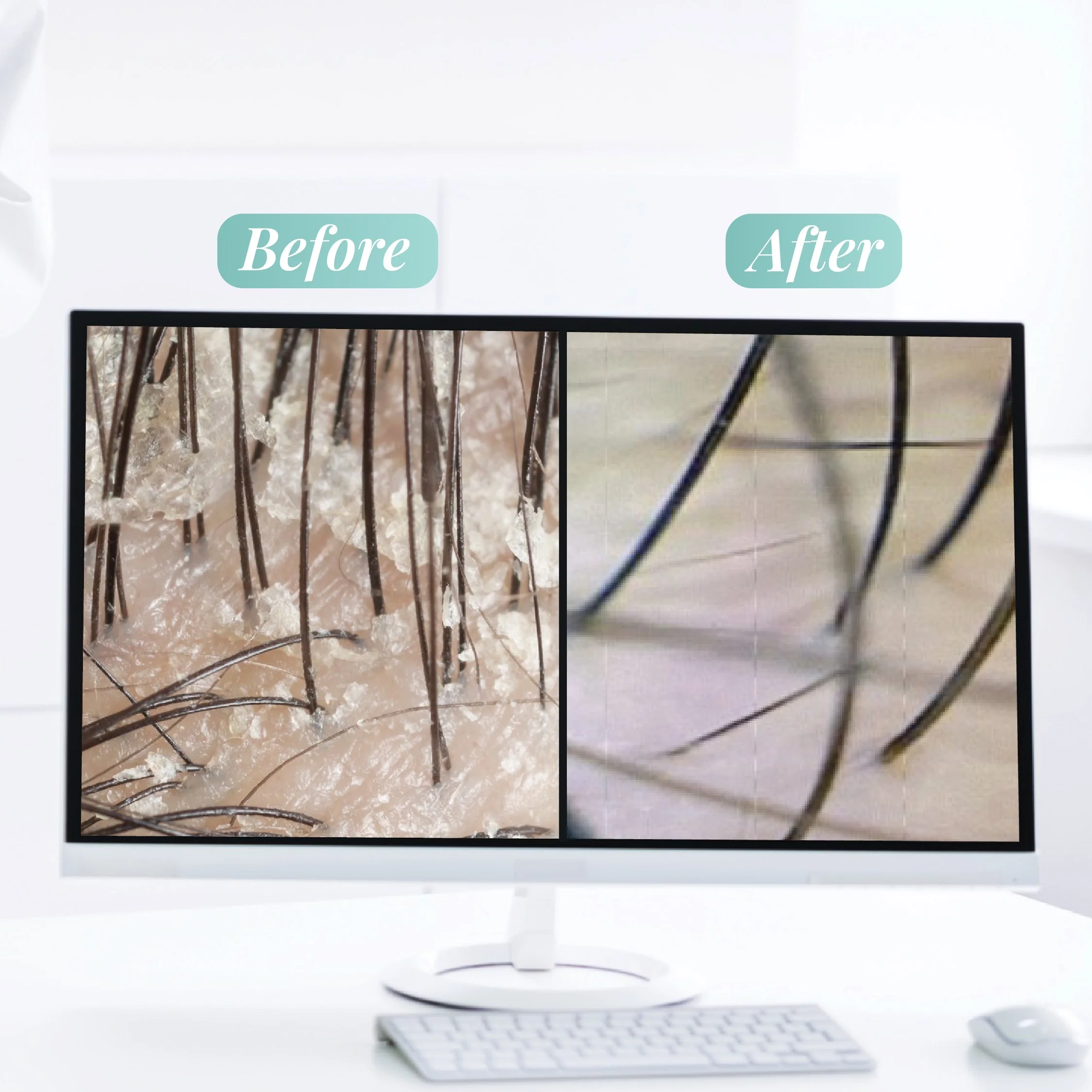 Comparison of skin before and after exfoliation, showing removal of dead skin cells and hair follicles on a computer monitor.