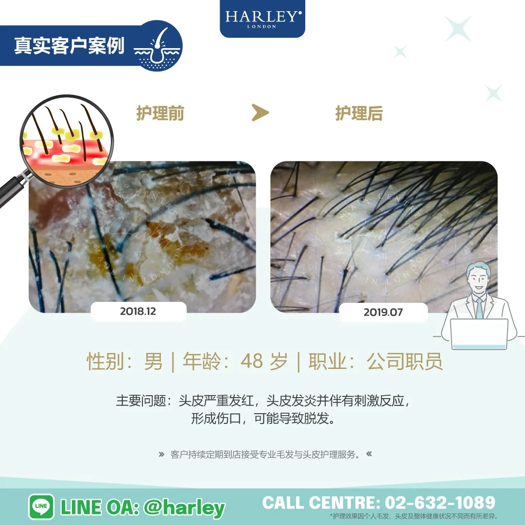 真实客户护理案例，48 岁男性客户因头皮严重发红、头皮发炎、刺激反应及形成伤口（可能导致脱发）而接受 Harley St. Hair Centre 专业毛发与头皮护理。护理后，头皮状况明显改善，炎症及刺激反应减轻，并持续定期到店接受专业护理。