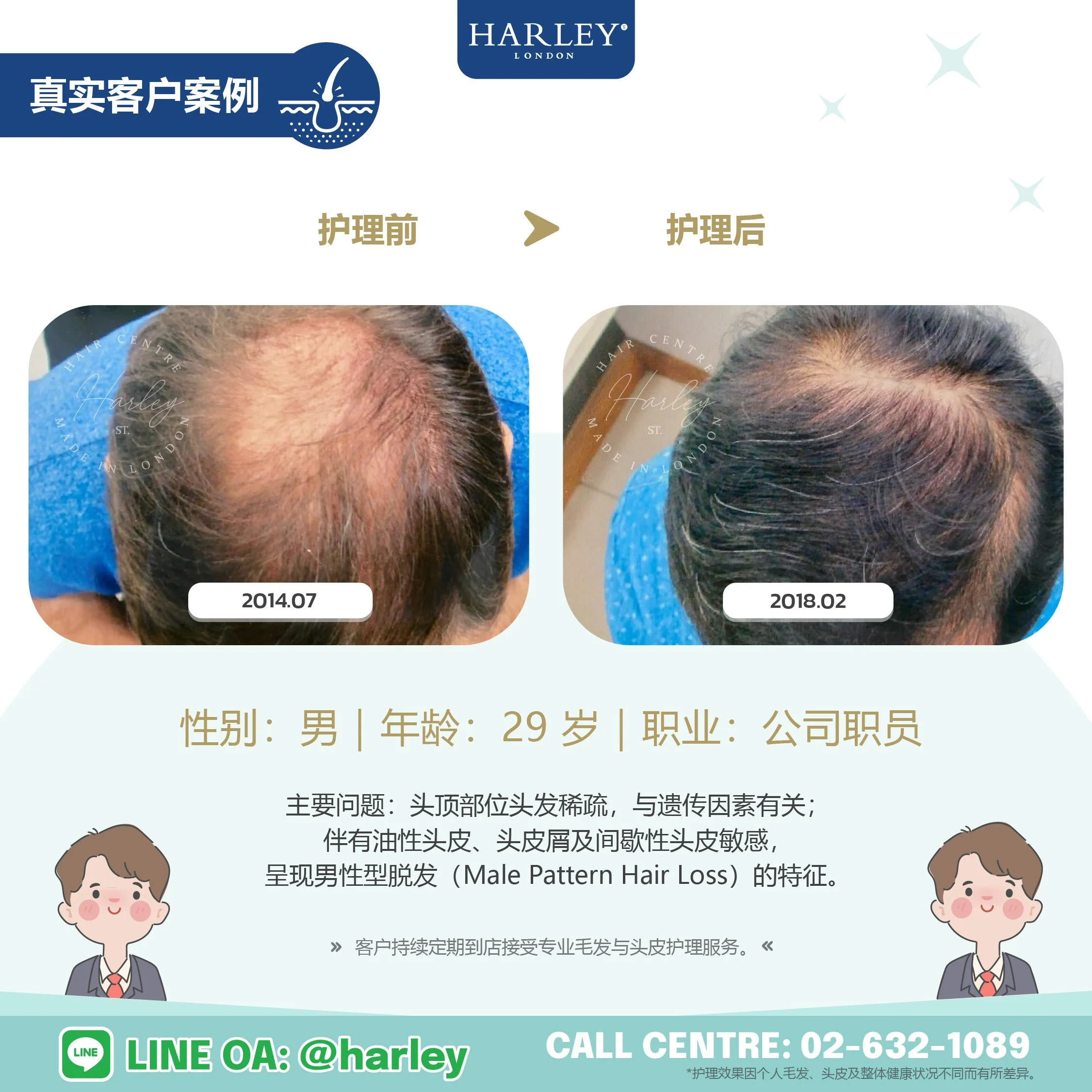 29 岁男性客户雄性型脱发（Male Pattern Hair Loss）护理前后真实案例，头顶部位头发密度改善，接受 Harley St. Hair Centre 专业毛发与头皮护理。