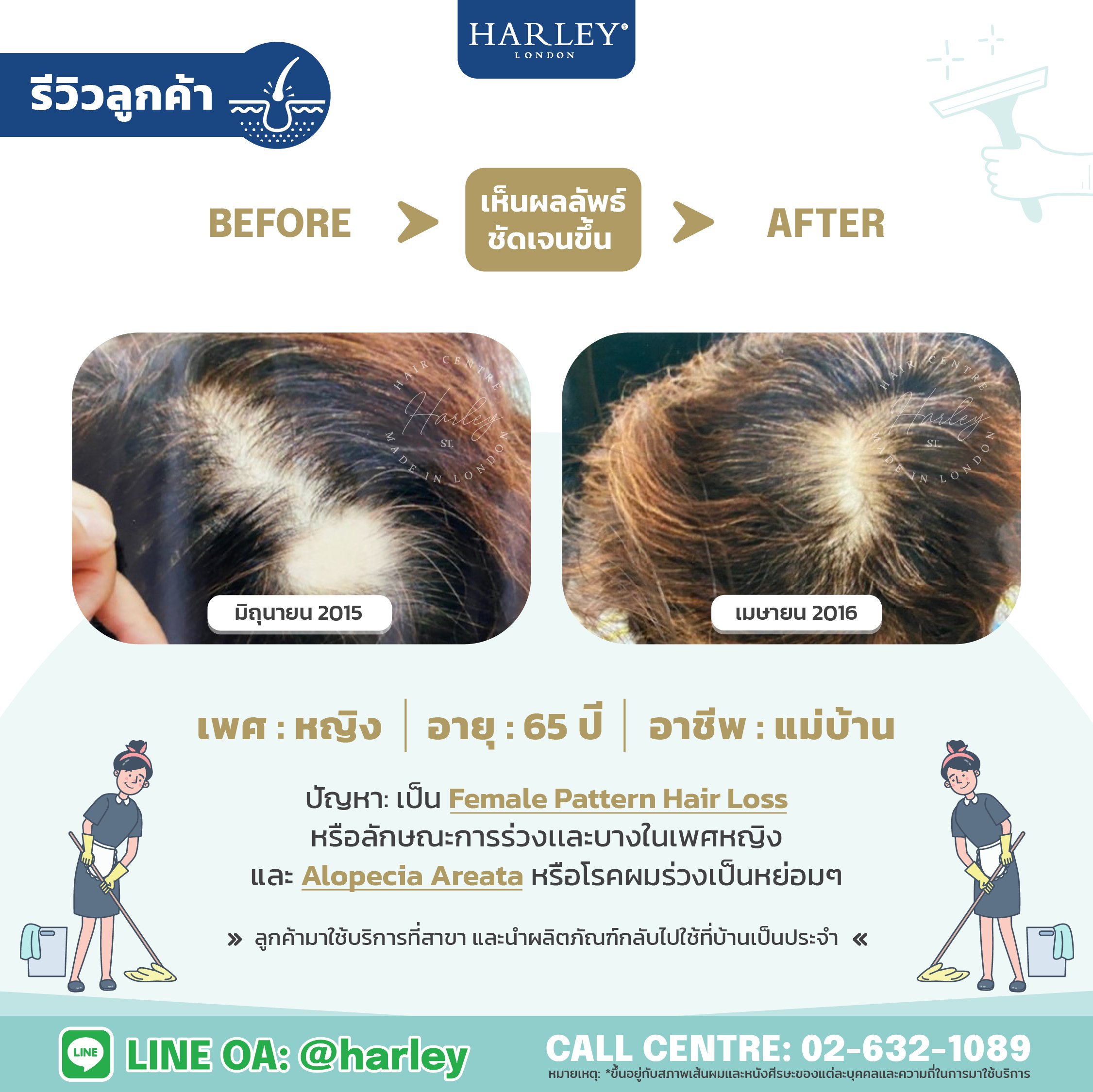 รีวิวลูกค้าเพศหญิงอายุ 65 ปี ผมร่วงเป็นหย่อมๆ Alopecia Areata