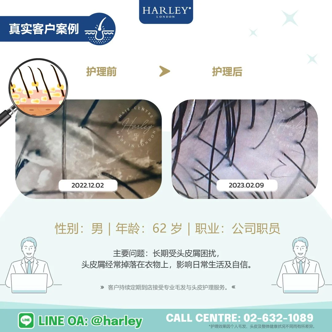 真实客户护理案例，62 岁男性客户因长期头皮屑问题，头皮屑经常掉落在衣物上，影响日常生活及自信，而接受 Harley St. Hair Centre 专业毛发与头皮护理。护理后，头皮屑明显减少，头皮更加健康，客户持续定期到店接受专业护理。