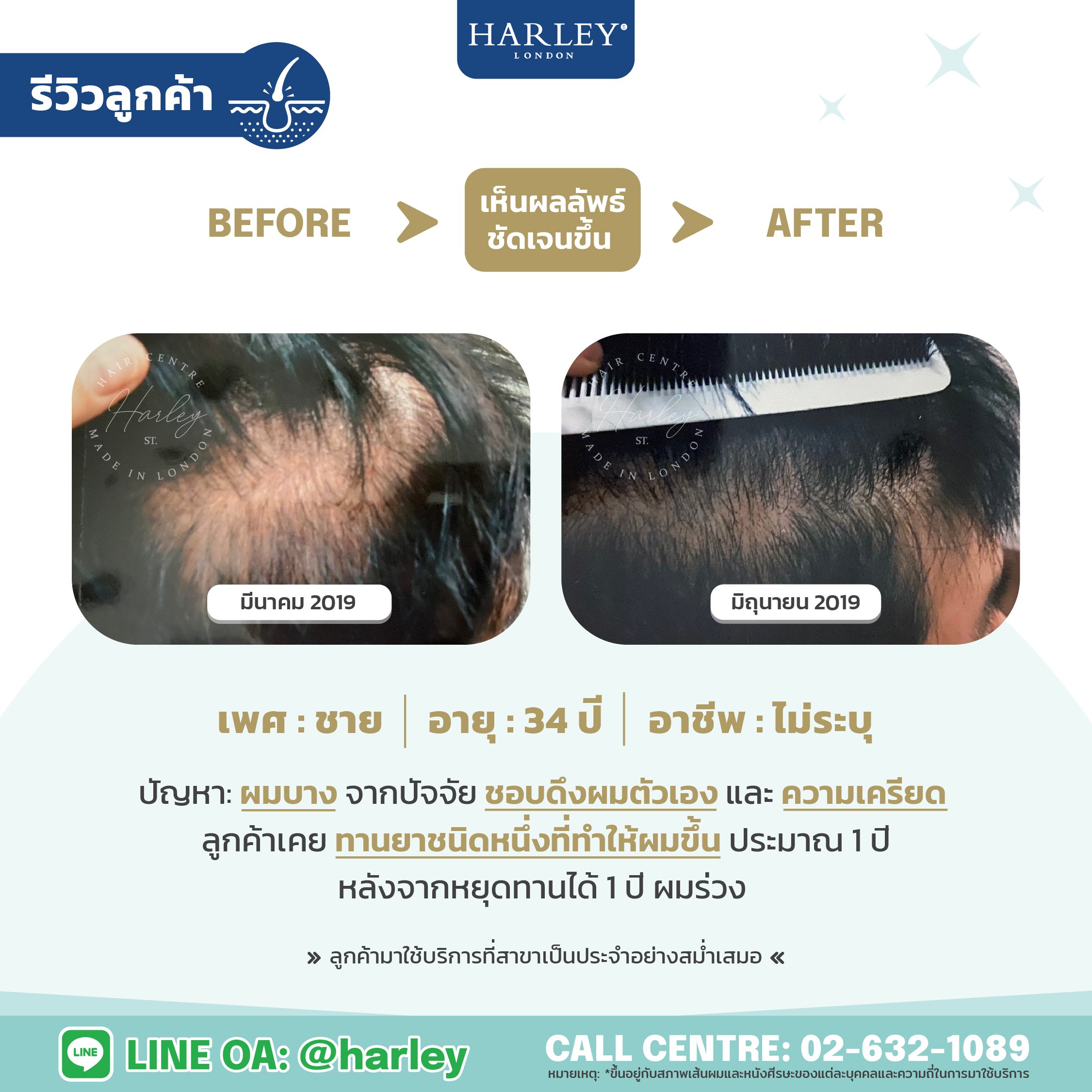 รีวิวลูกค้าเพศชายอายุ 34 ปี ผมบางจากการดึงผมตัวเองและความเครียด