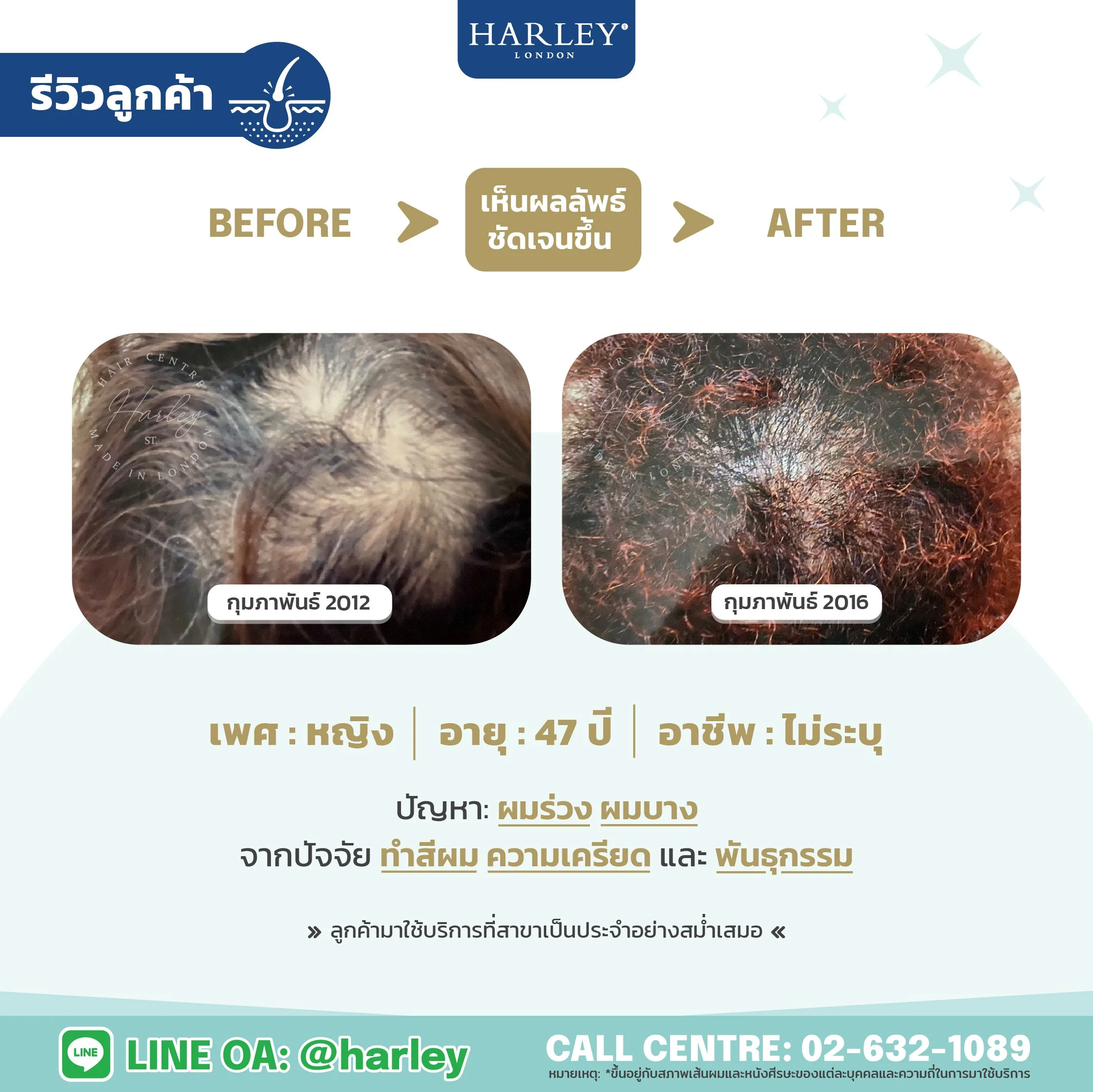 รีวิวลูกค้าเพศหญิงอายุ 47 ปี ผมร่วงผมบาง จากการทำสีผม และความเครียด