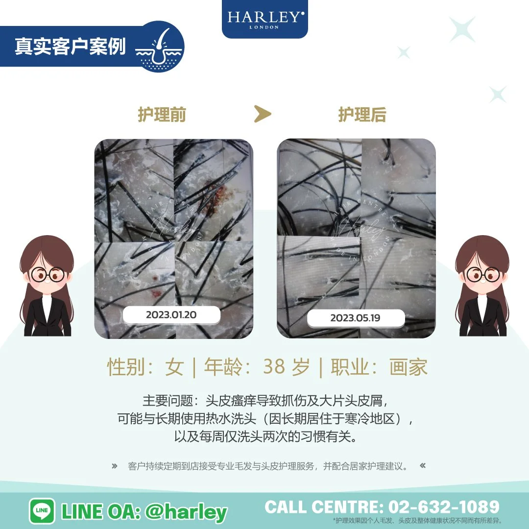 真实客户护理案例，35 岁女性客户因头皮瘙痒导致抓伤及大量头皮屑，长期使用热水洗头及洗头频率较低，而接受 Harley St. Hair Centre 专业毛发与头皮护理。护理后，头皮状况明显改善，头皮屑减少，瘙痒症状缓解，并持续定期到店接受专业护理。