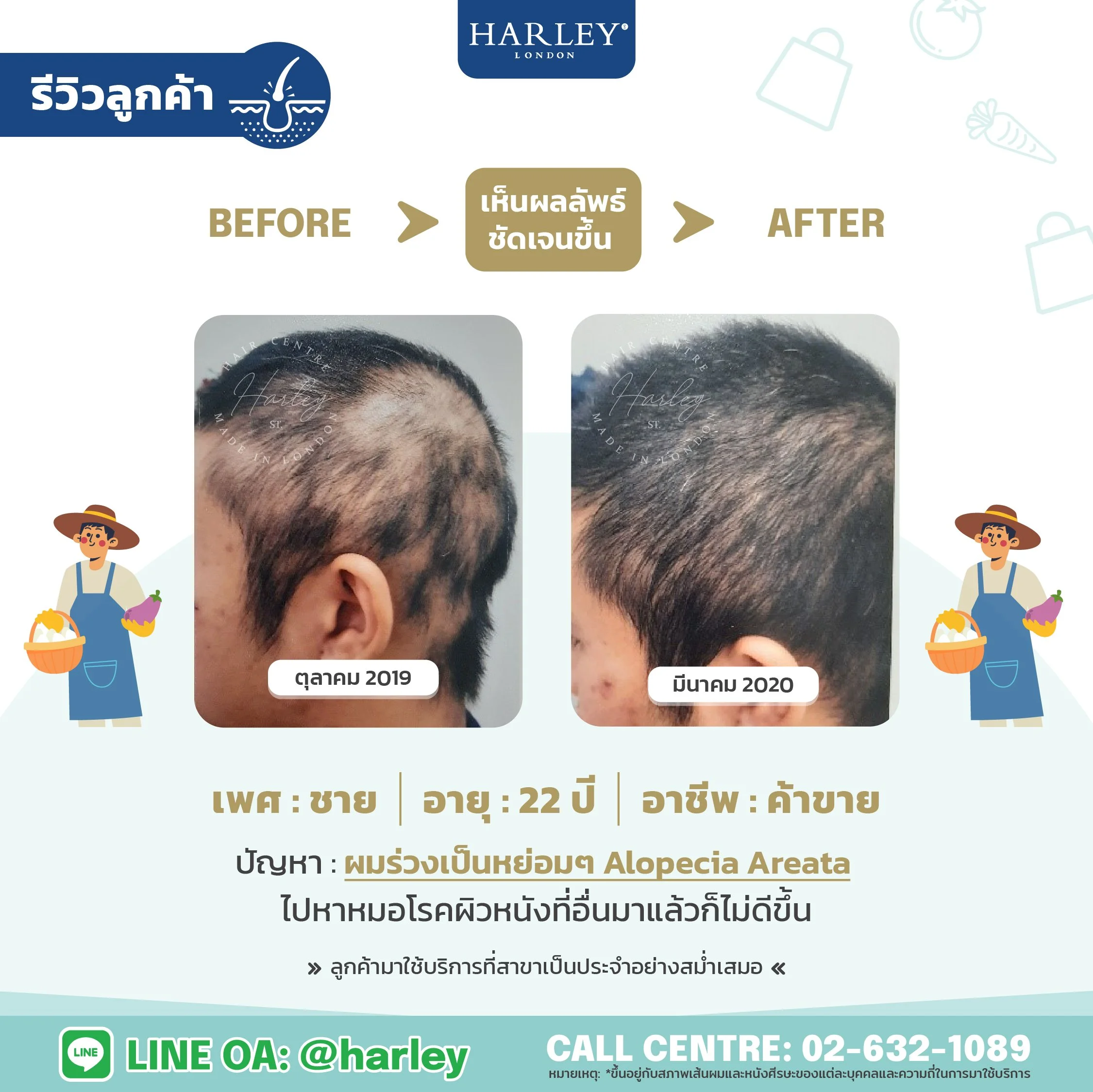 รีวิวลูกค้าเพศชายอายุ 22 ปี ผมร่วงเป็นหย่อม Alopecia Areata