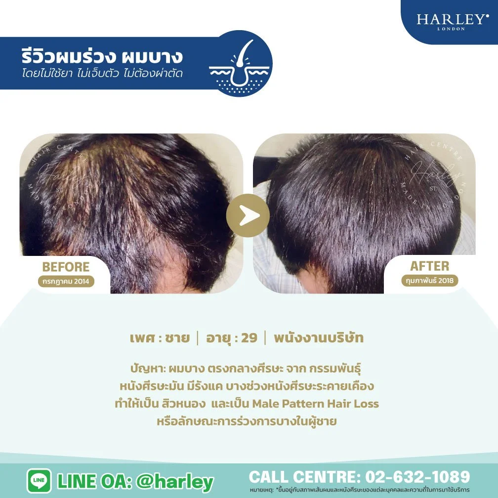 รีวิวฟื้นฟูผมบางกลางศีรษะ Male Pattern Hair Loss ชาย 29 ปี Harley St. Hair Centre สาขาบางนา