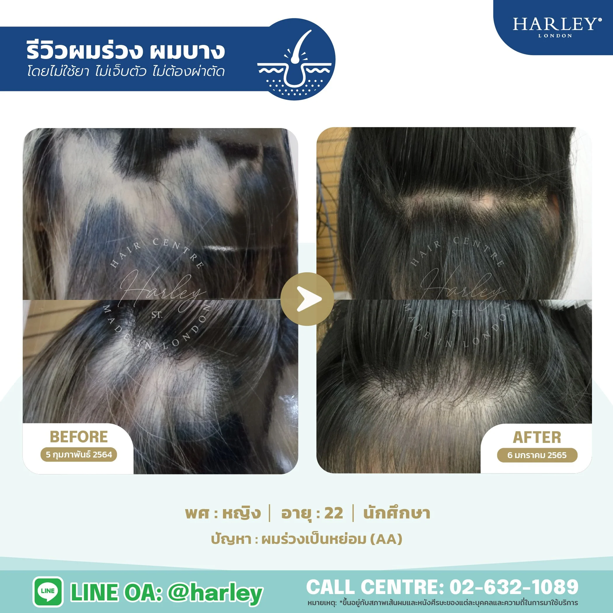 รีวิวรักษาโรคผมร่วงเป็นหย่อม (AA) บริเวณท้ายทอยและหนังศีรษะในผู้หญิง อายุ 22 ปี วัยนักศึกษา โดย Harley St. Hair Centre เปรียบเทียบภาพ Before และ After หลังการฟื้นฟูเส้นผมแบบไม่ใช้ยา