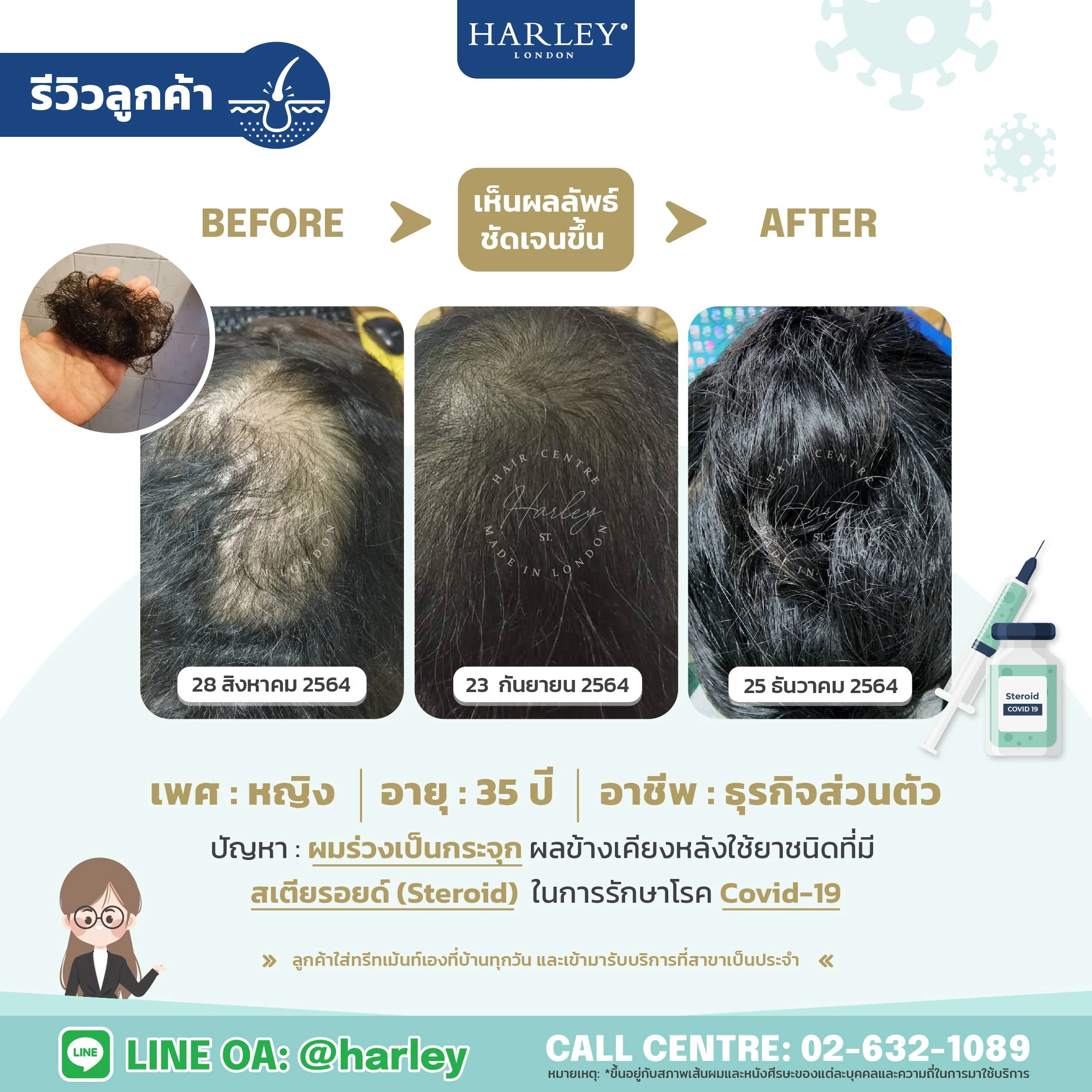 รีวิวลูกค้าเพศหญิงอายุ 35 ปี ผมร่วงเป็นกระจกกลางศีรษะจากผลข้างเคียงโควิด 19
