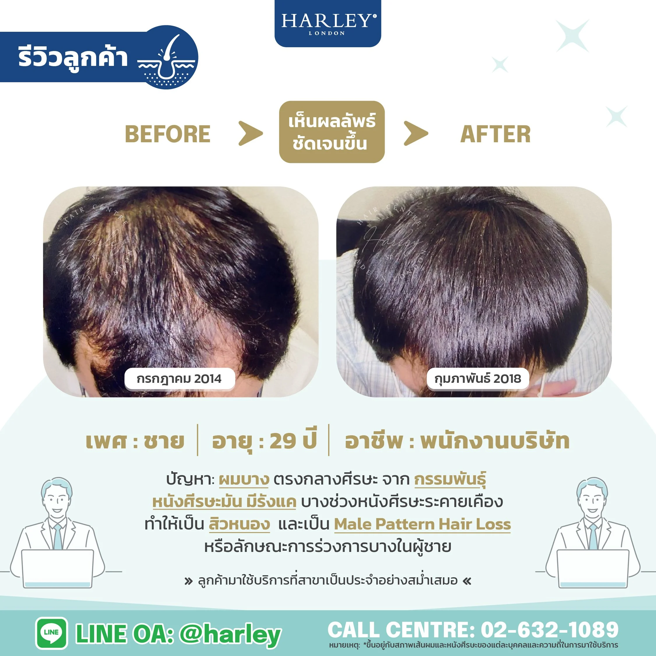 รีวิวลูกค้าเพศชายอายุ 29 ปี ผมบางกรรมพันธุ์ ศีรษะมัน มีสิว