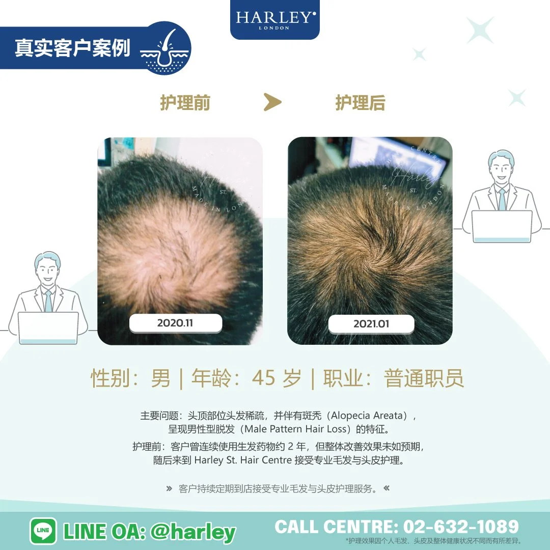 真实男性客户护理案例，记录斑秃（Alopecia Areata）及头顶部位头发稀疏的护理变化。客户头发呈现男性型脱发（Male Pattern Hair Loss）的稀疏特征，并持续接受专业毛发与头皮护理及配合居家护理建议，头发逐步恢复生长。护理效果因个人毛发、头皮及整体健康状况不同而有所差异。